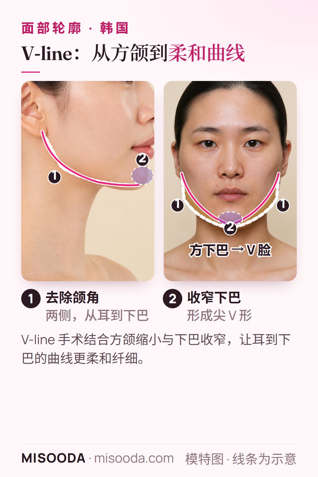 韩国 V-line 手术:去除两侧方颌角并将下巴收窄成 V 形,以侧脸与正面示意图呈现