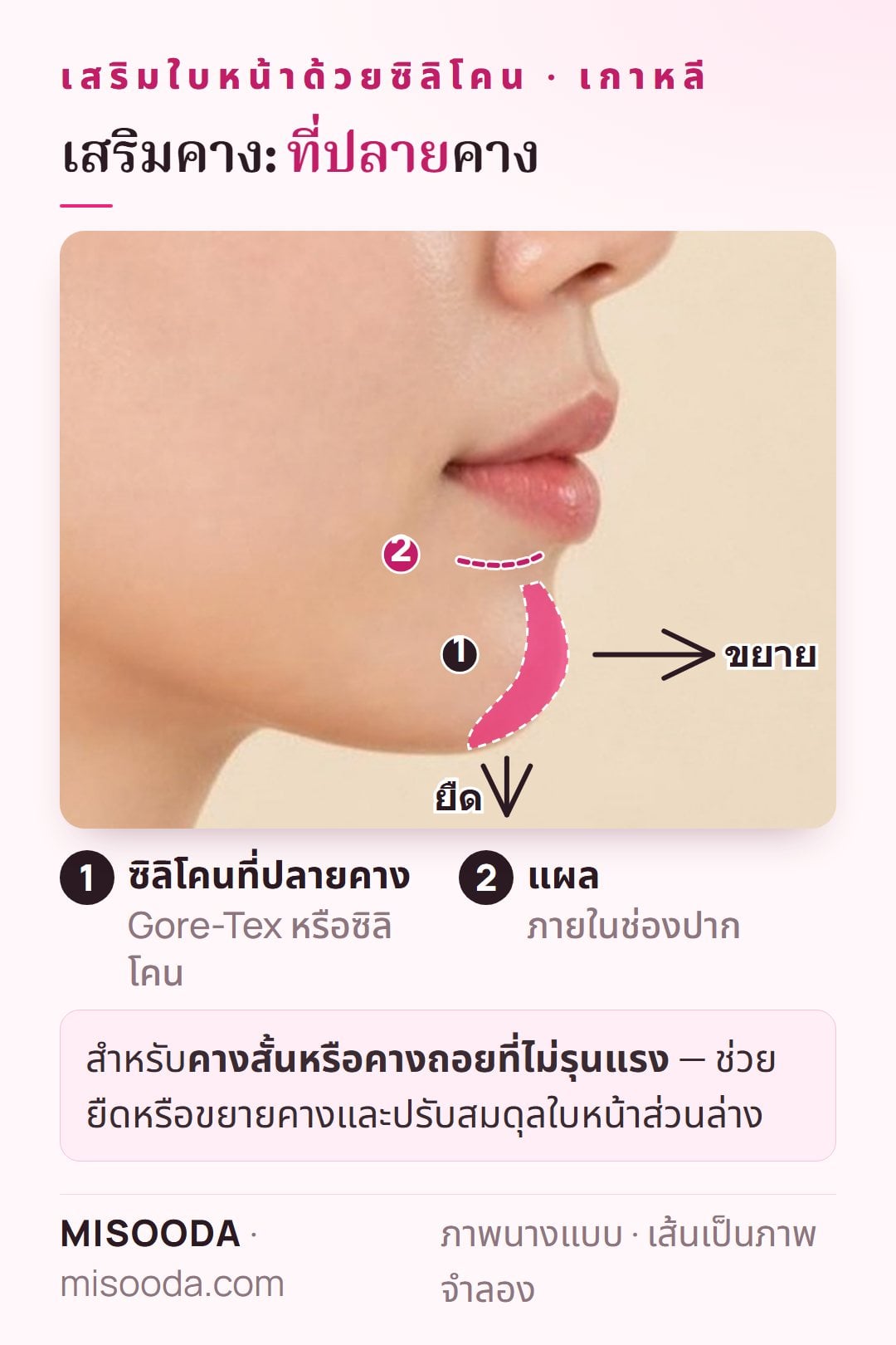 เสริมคางในเกาหลี: ใส่ Gore-Tex หรือซิลิโคนที่ปลายคางผ่านแผลในช่องปาก เพื่อยืดหรือขยายคางที่สั้นหรือถอย