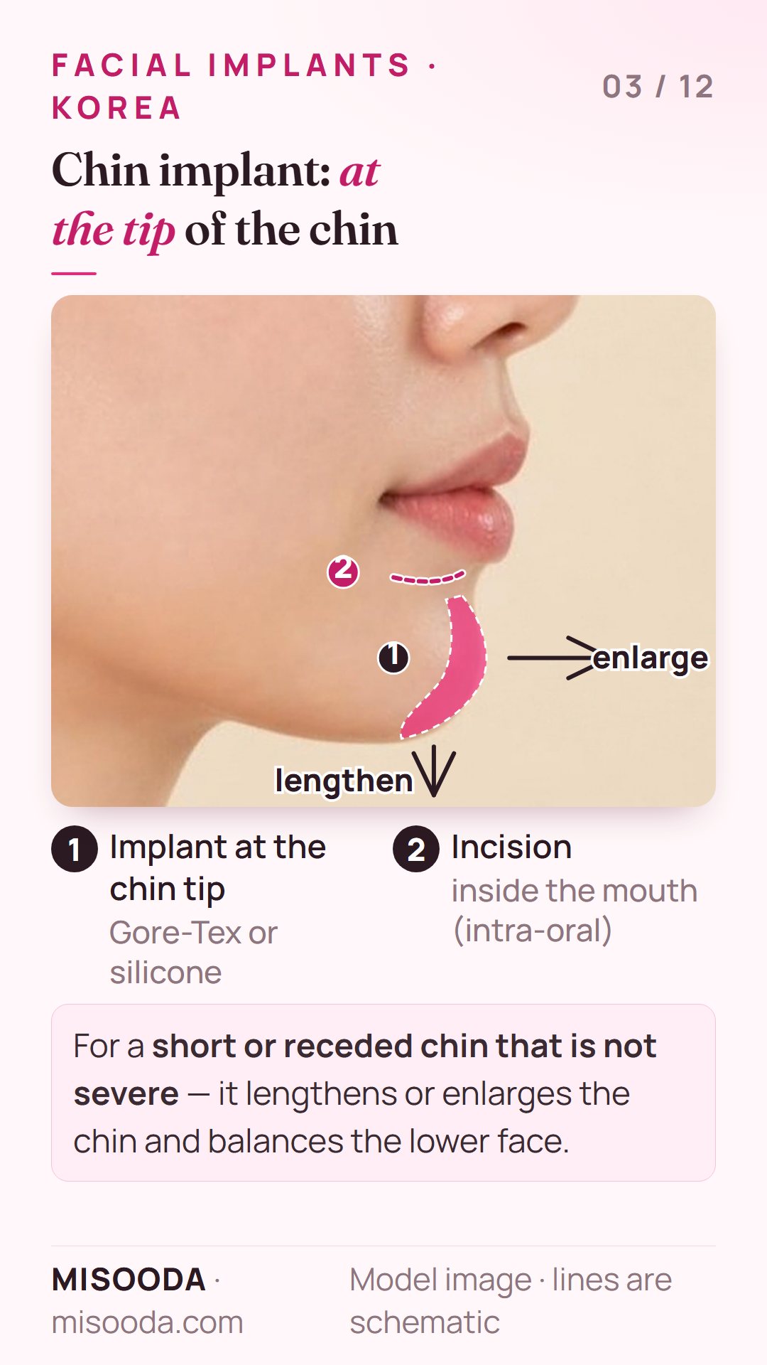Chin implant in Korea: a Gore-Tex or silicone implant placed at the chin tip through an intra-oral incision to lengthen or enlarge a short or receded chin
