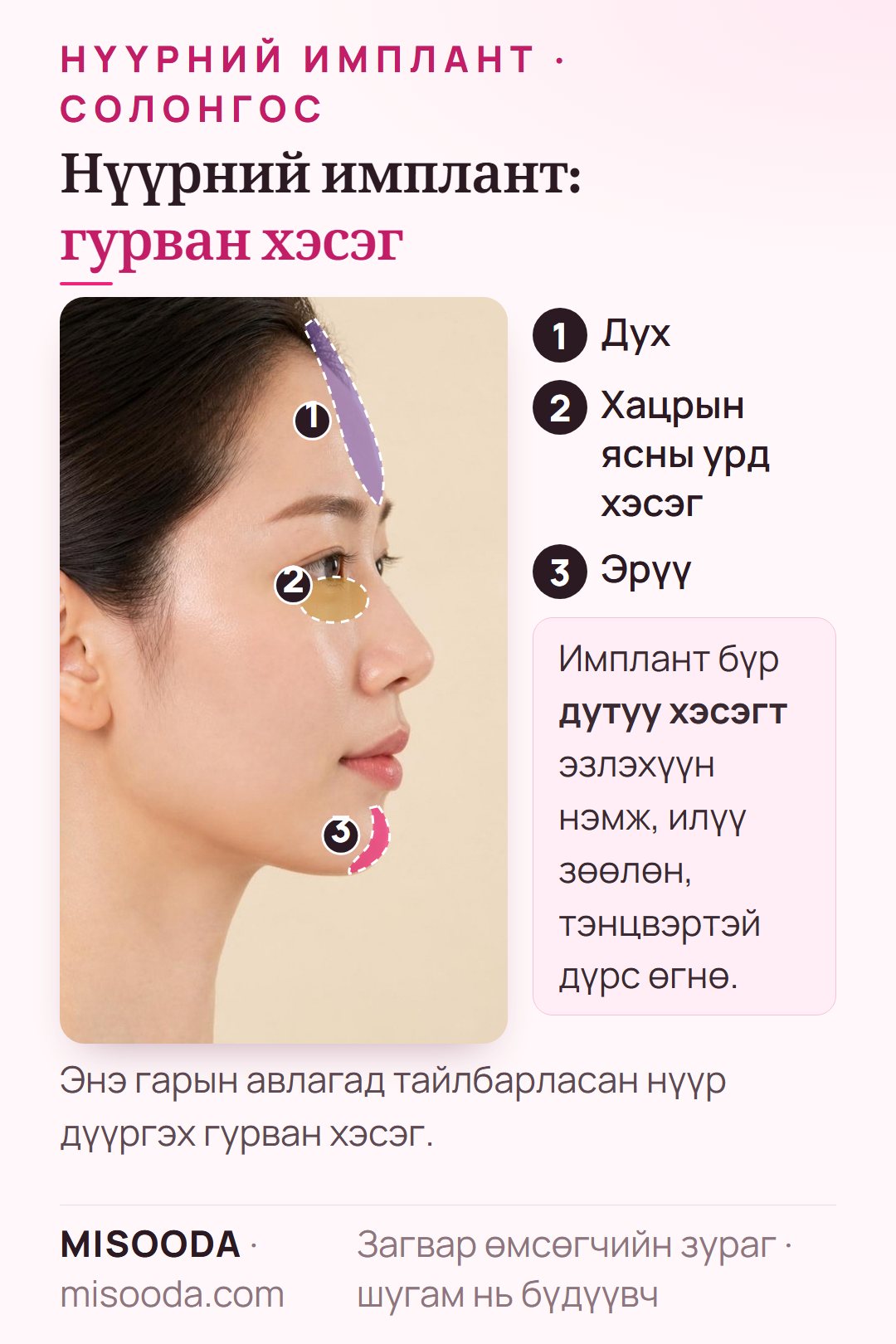 Солонгост нүүрний имплантын хэсгүүд хажуу дүрс дээр: захиалгат духны имплант, нүдний доорх хацрын ясны урд (зигома) имплант ба эрүүний үзүүрийн имплант