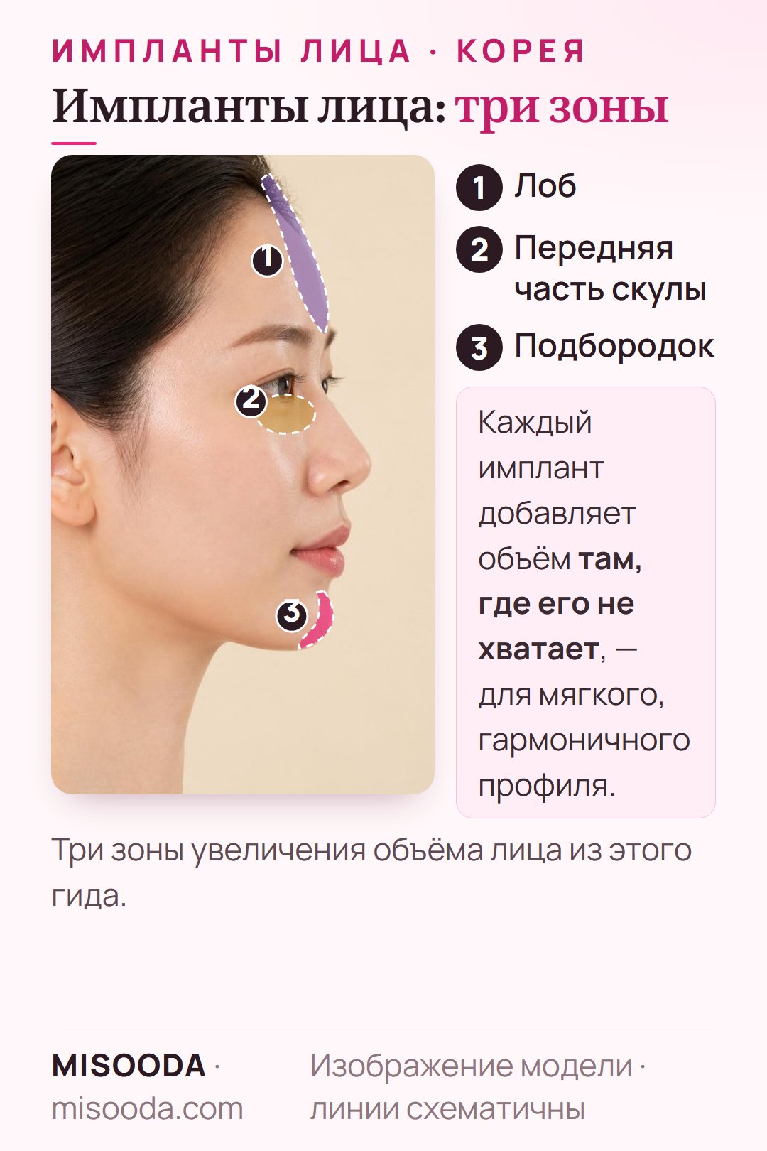 Зоны имплантов лица в Корее в профиль: индивидуальный имплант лба, имплант передней части скулы под глазами и имплант на кончике подбородка