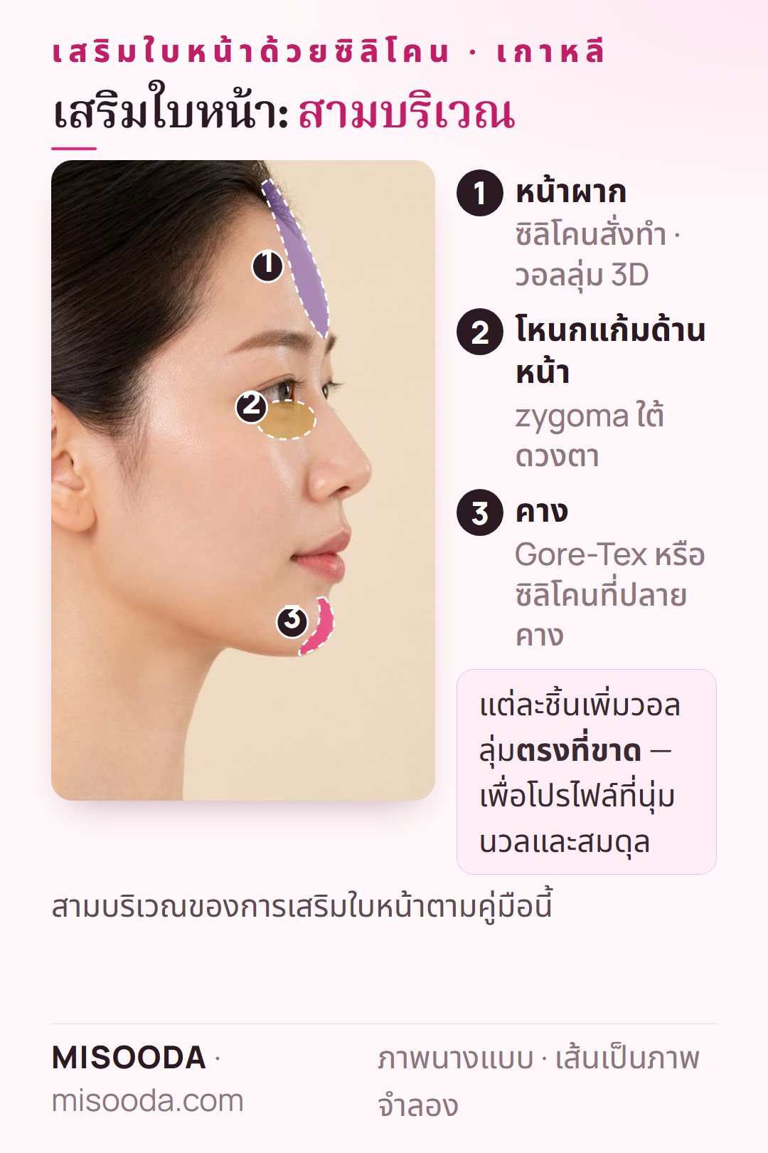 บริเวณเสริมใบหน้าในเกาหลีบนภาพด้านข้าง: เสริมหน้าผากซิลิโคนสั่งทำ เสริมโหนกแก้มด้านหน้า (zygoma) ใต้ดวงตา และเสริมคางที่ปลายคาง