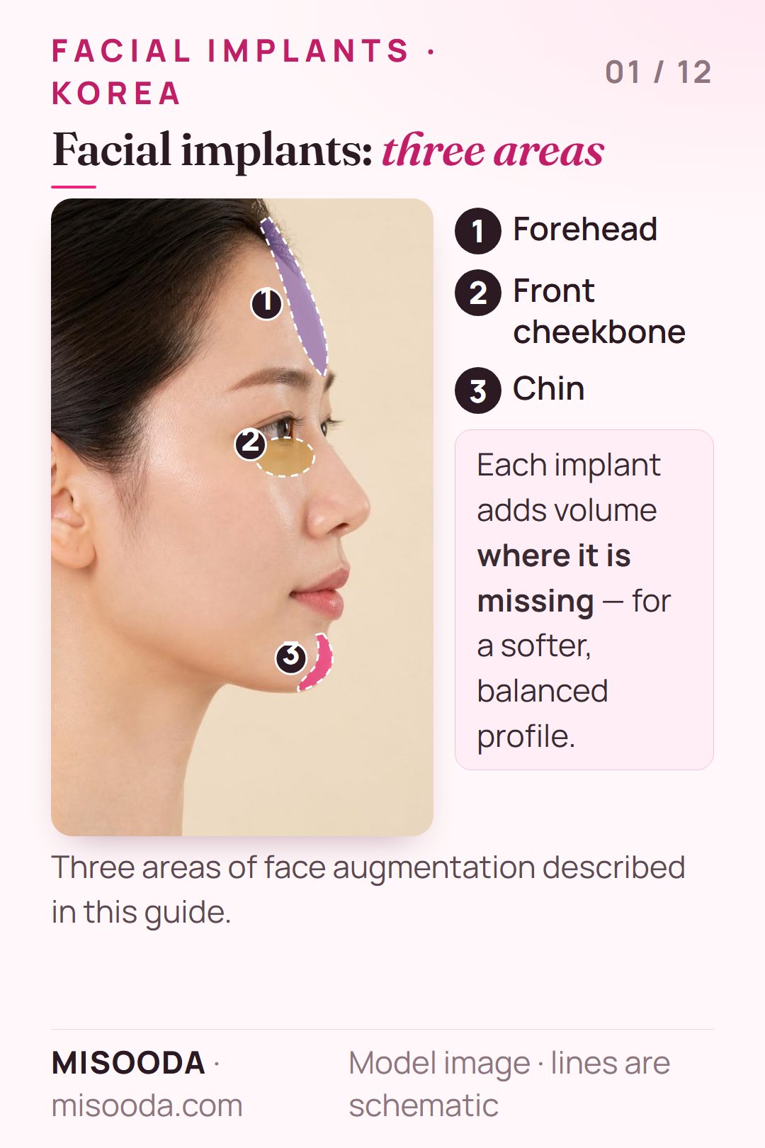 Facial implant areas in Korea shown on a side profile: custom forehead implant, front cheekbone (zygoma) implant under the eyes and a chin implant at the tip