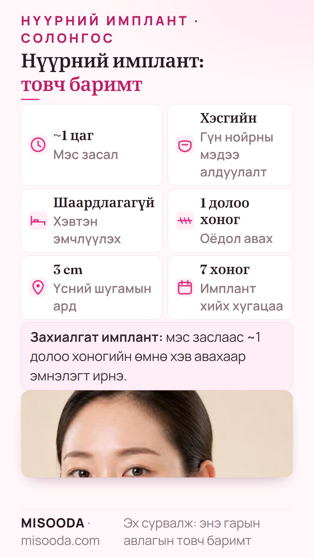 Нүүрний имплантын товч баримт: хэсгийн гүн нойрны мэдээ алдуулалтаар ~1 цаг, хэвтэх шаардлагагүй, 1 долоо хоногт оёдол авна, захиалгат имплант 7 хоногт