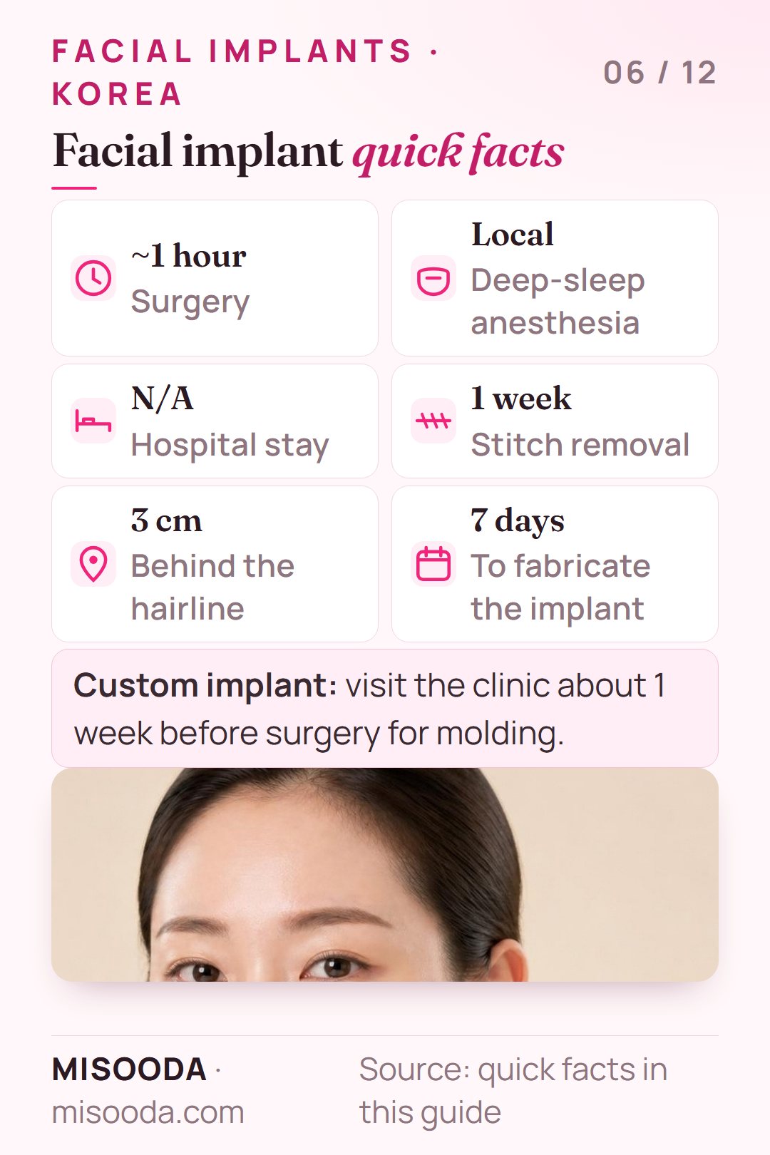 Facial implant surgery quick facts: about 1 hour under local deep-sleep anesthesia, no hospital stay, stitches out after 1 week, custom implant made in 7 days