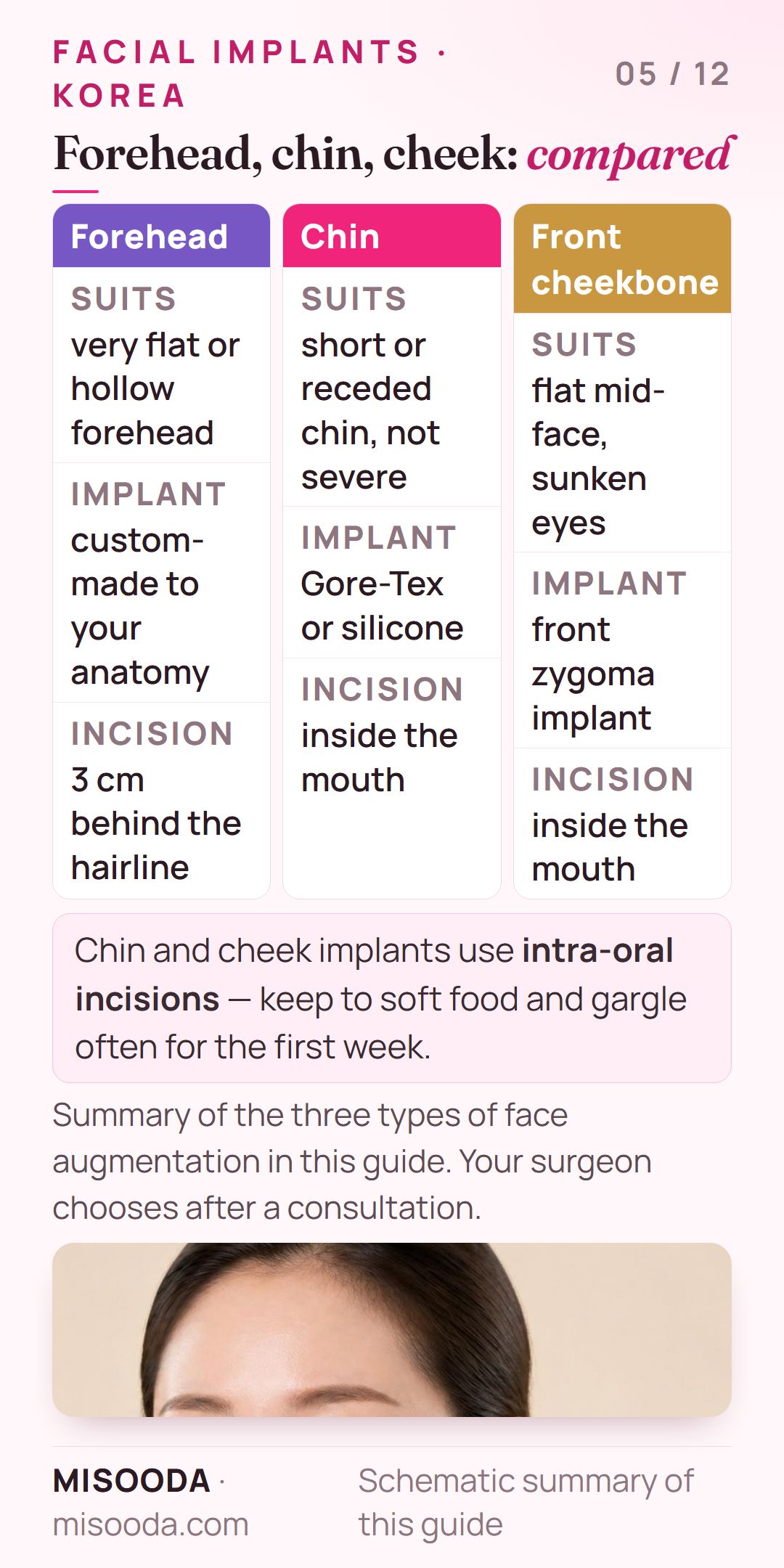 Facial implant types compared: custom forehead implant via incision 3 cm behind the hairline, Gore-Tex or silicone chin implant, front zygoma implant