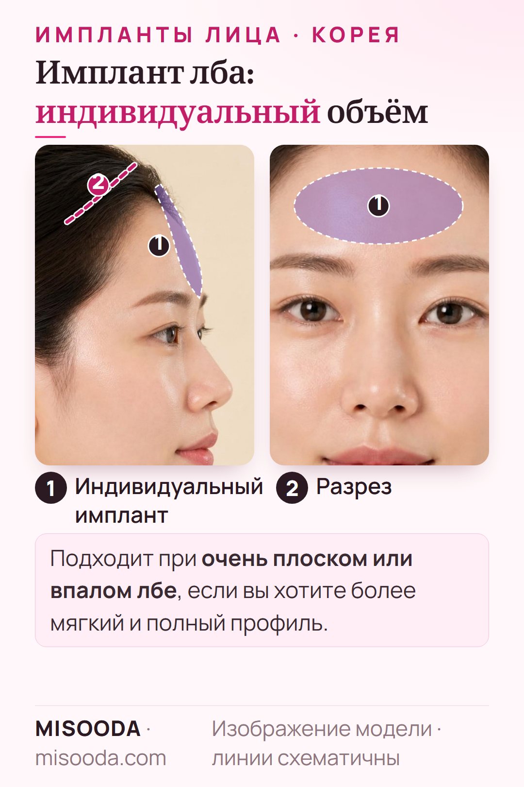 Имплант лба в Корее: индивидуальный имплант добавляет объём плоскому или впалому лбу через разрез 3 см за линией роста волос