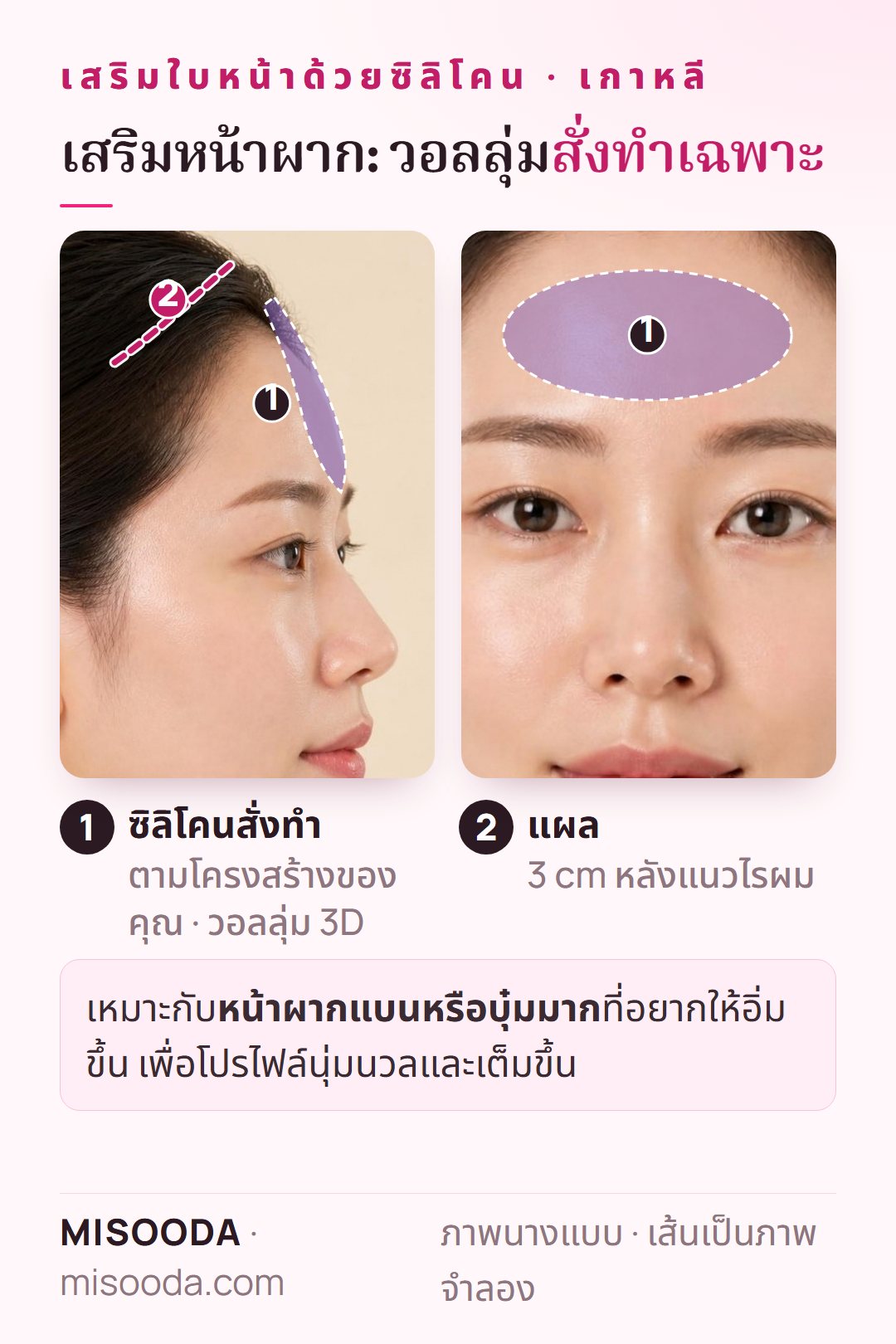 เสริมหน้าผากในเกาหลี: ซิลิโคนสั่งทำเพิ่มวอลลุ่มสามมิติให้หน้าผากที่แบนหรือบุ๋ม ผ่านแผล 3 cm หลังแนวไรผม
