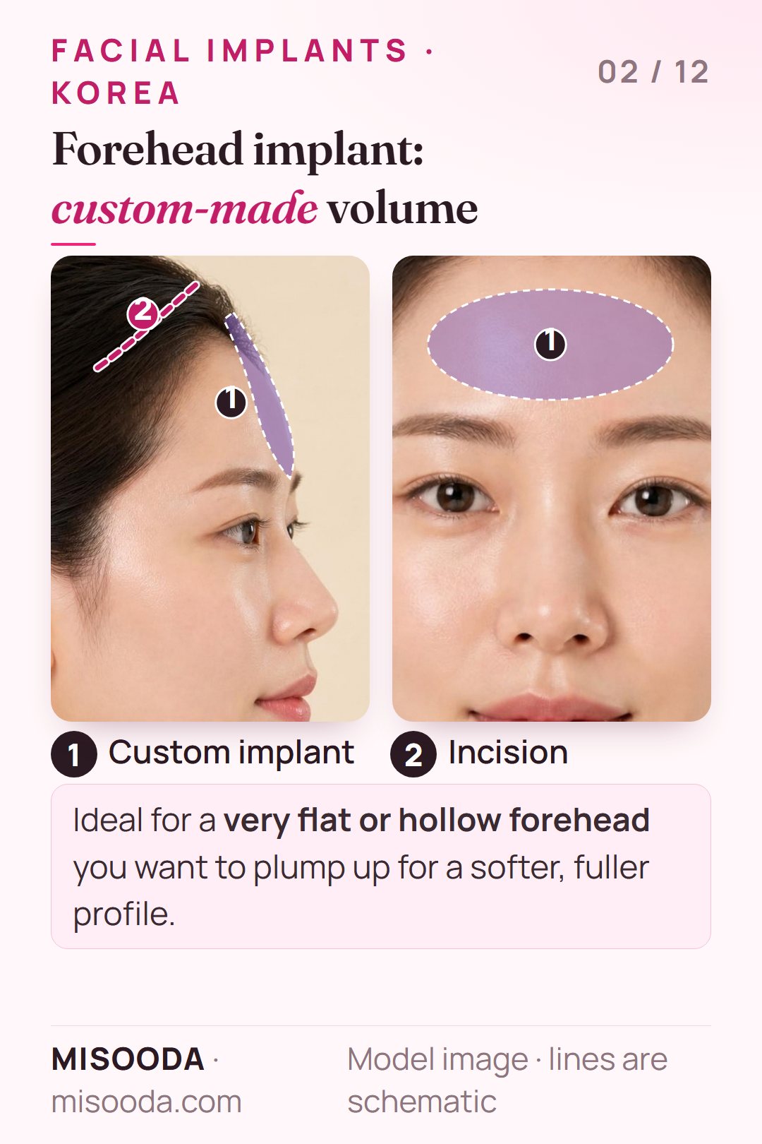 Forehead implant in Korea: a custom-made implant adds three-dimensional volume to a flat or hollow forehead through an incision 3 cm behind the hairline