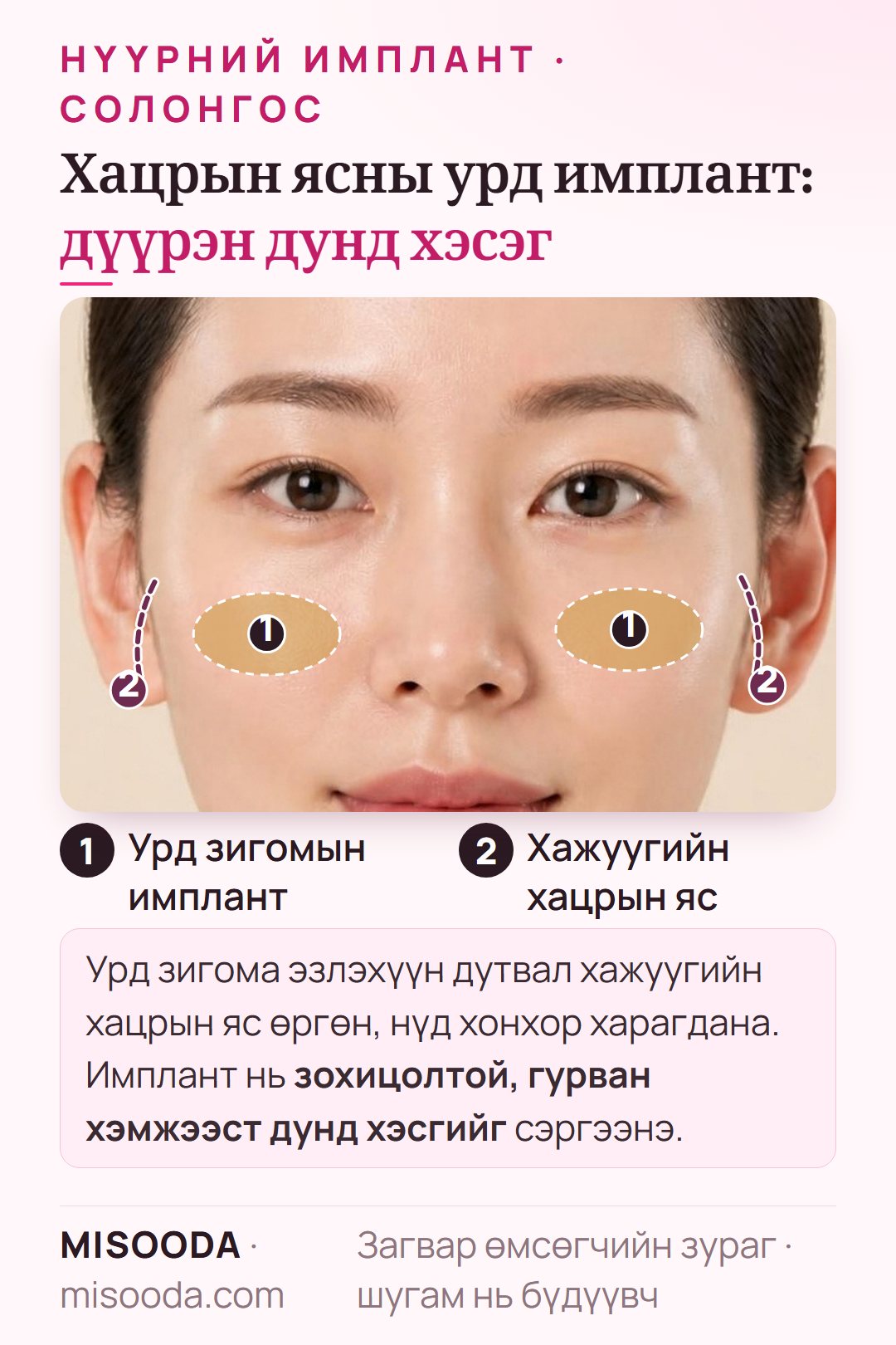 Солонгост хацрын ясны урд (зигома) имплант: нүдний доор эзлэхүүн нэмснээр хажуугийн хацрын яс өргөн, нүд хонхор харагдахаа больно