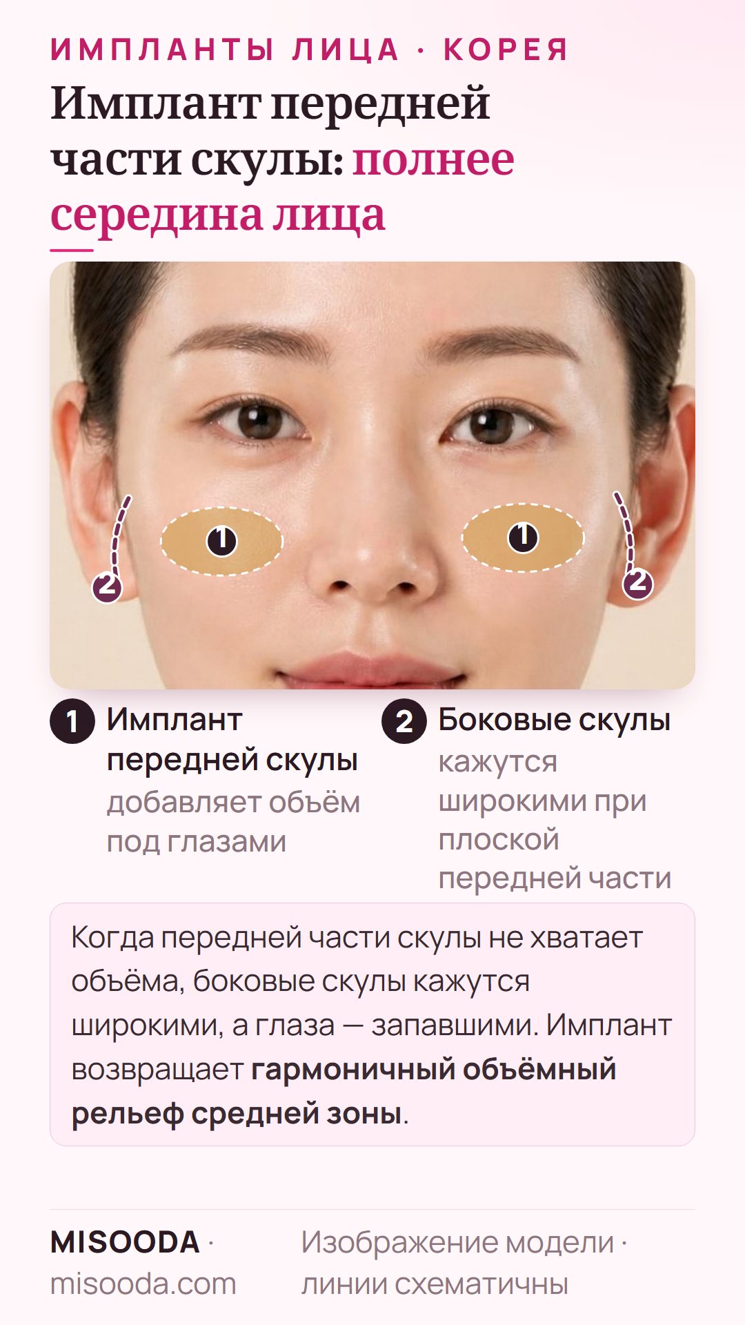 Имплант передней части скулы в Корее: объём под глазами, чтобы боковые скулы не казались широкими, а глаза — запавшими