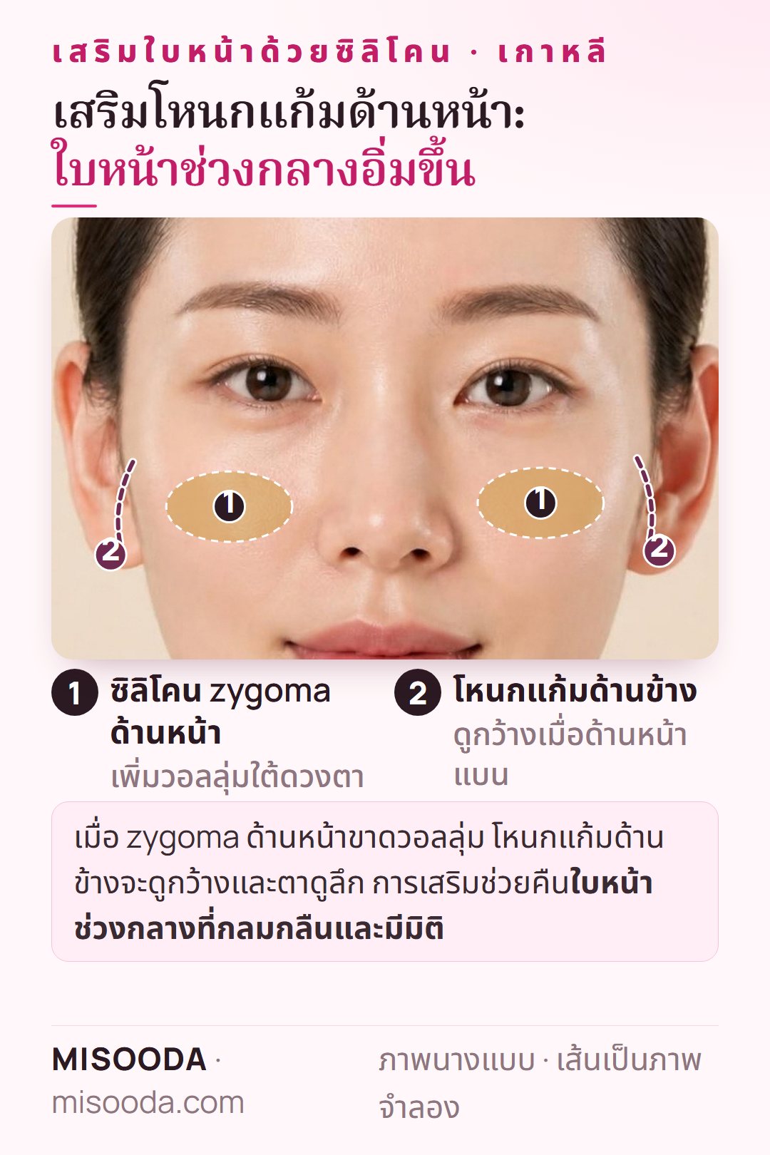 เสริมโหนกแก้มด้านหน้า (zygoma) ในเกาหลี: เพิ่มวอลลุ่มใต้ดวงตาเพื่อให้โหนกแก้มด้านข้างไม่ดูกว้างและตาไม่ดูลึก
