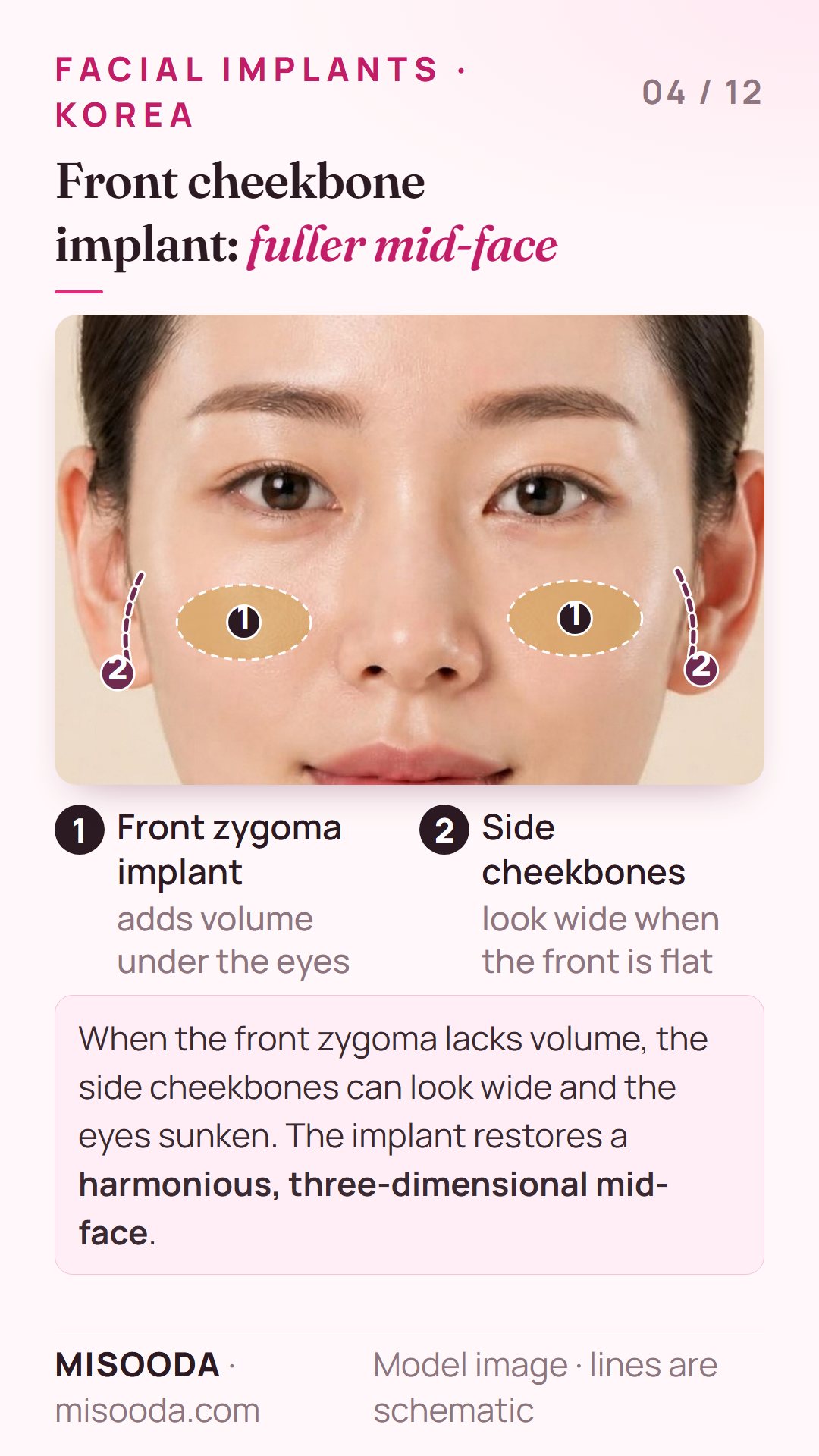 Front cheekbone (zygoma) implant in Korea: volume added under the eyes so the side cheekbones no longer look wide and the eyes no longer look sunken