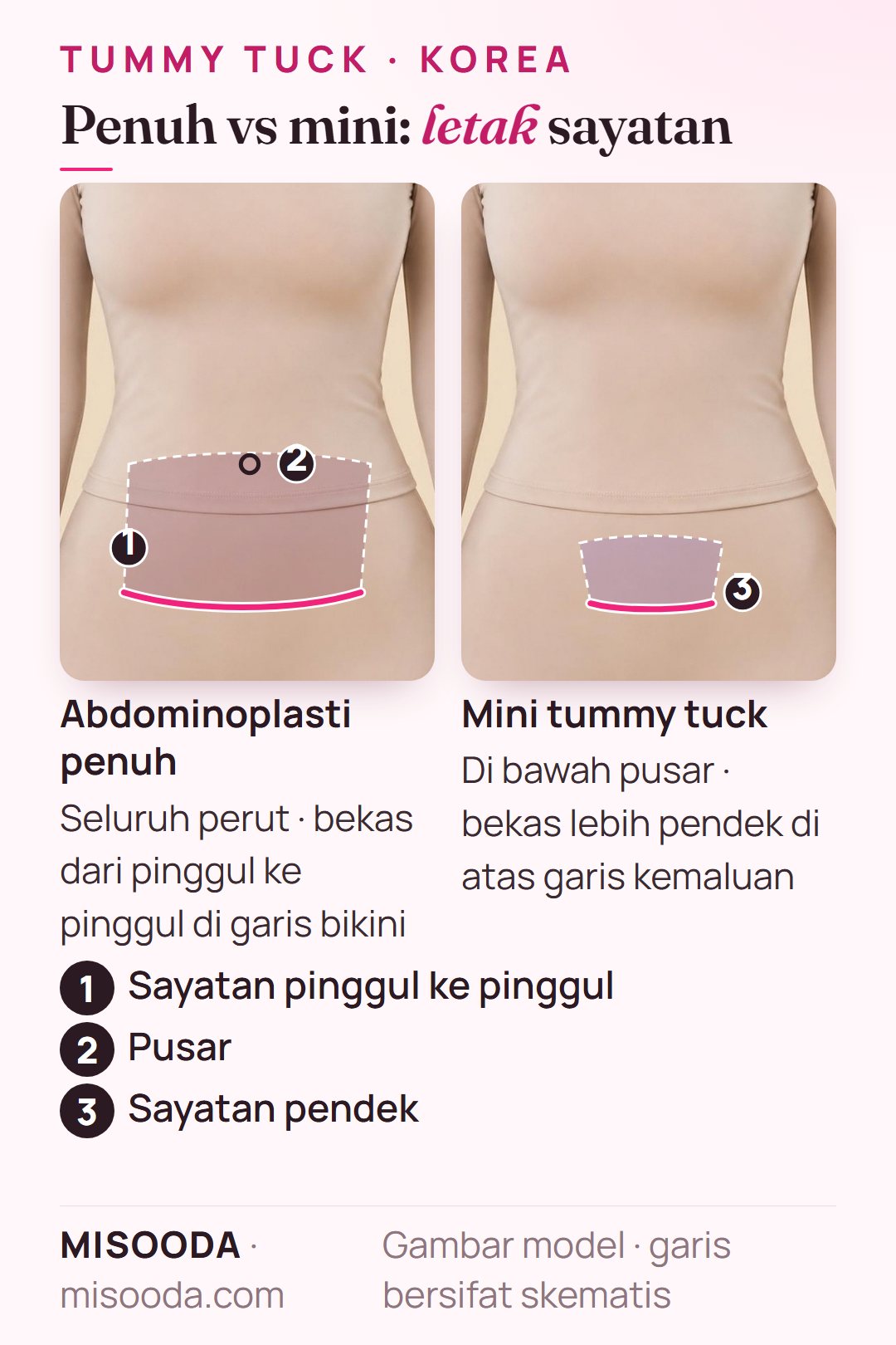 Sayatan abdominoplasti penuh vs mini tummy tuck: bekas pinggul ke pinggul di garis bikini dengan pusar dipindah vs bekas lebih pendek di atas garis kemaluan