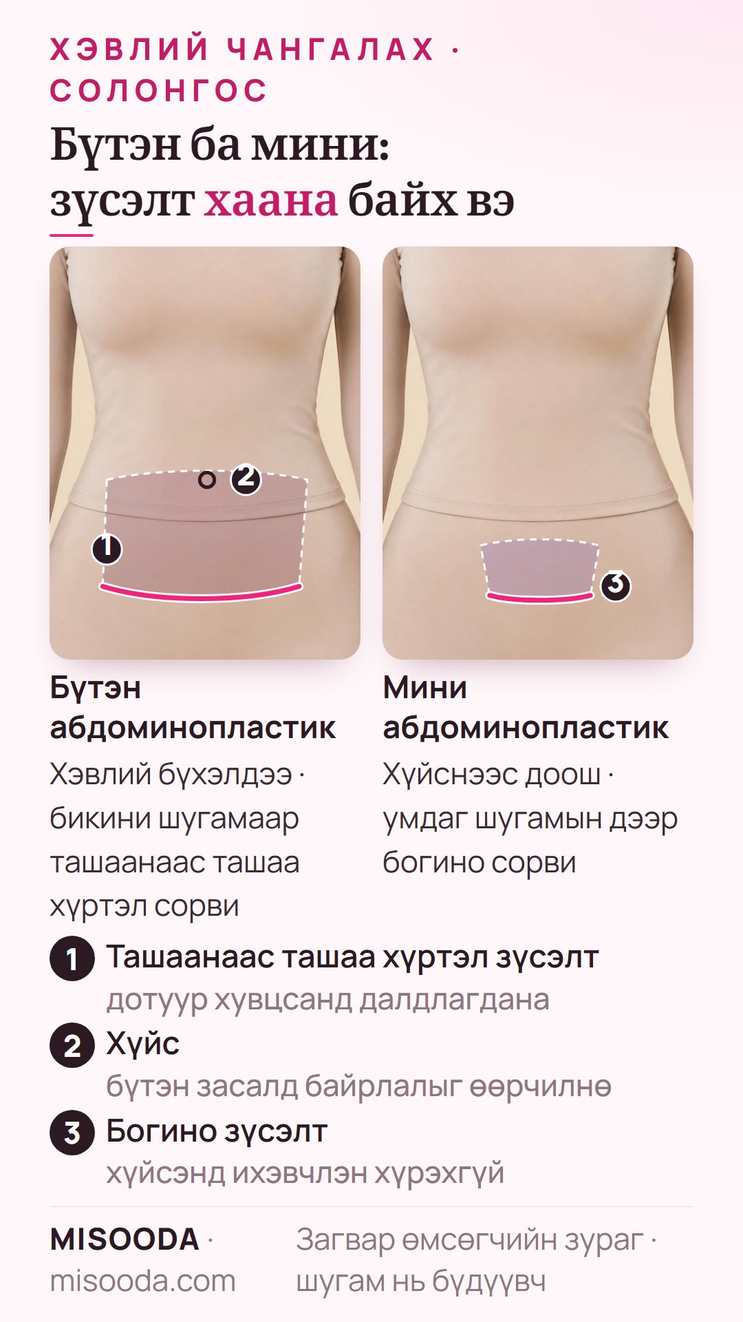 Бүтэн ба мини абдоминопластикийн зүсэлт: хүйсийг шилжүүлдэг бикини шугамын ташаанаас ташаа хүртэл сорви ба умдаг шугамын дээрх богино сорви