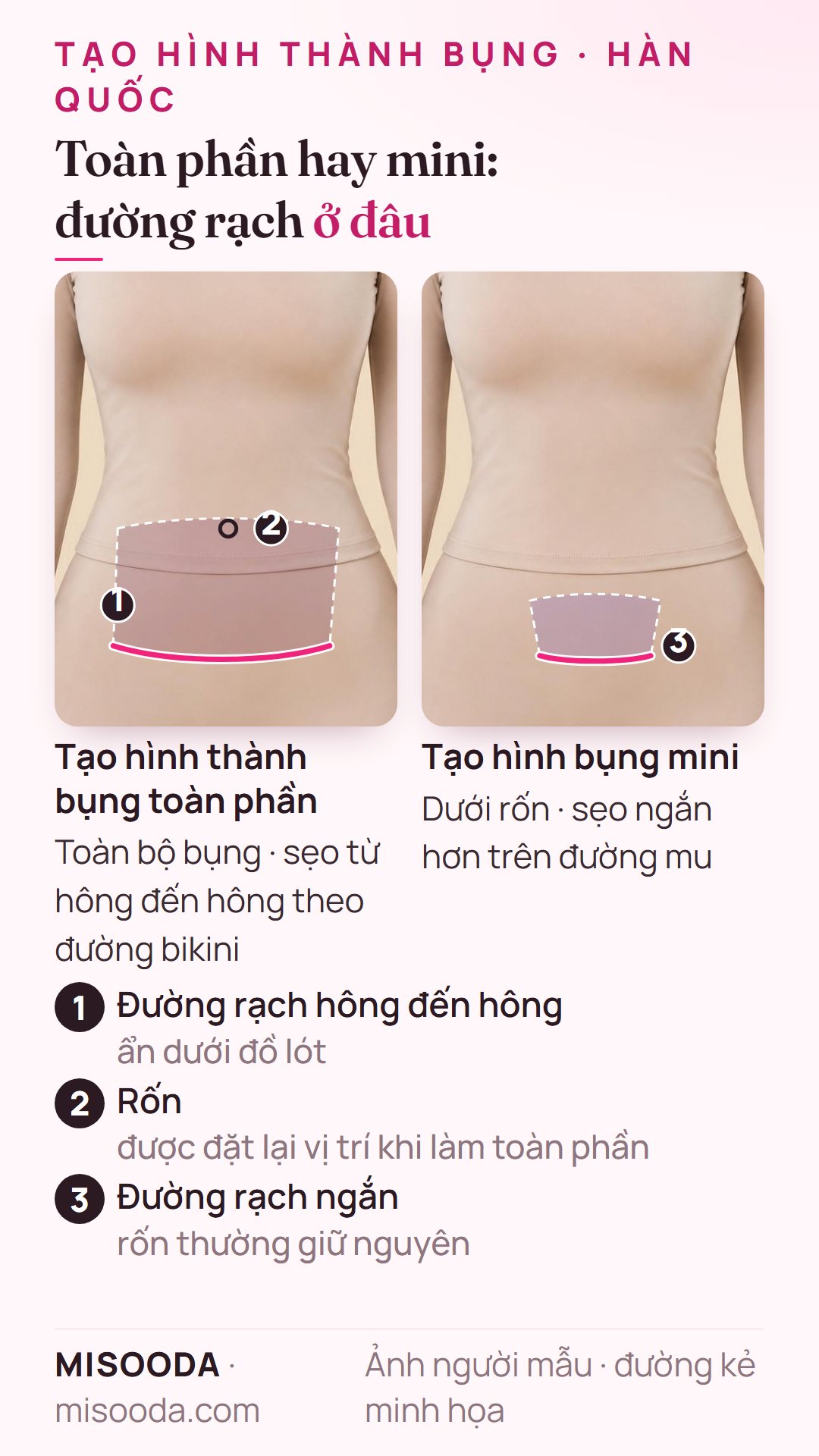 Đường rạch tạo hình thành bụng toàn phần và mini: sẹo hông đến hông theo đường bikini và dời rốn, so với sẹo ngắn hơn trên đường mu