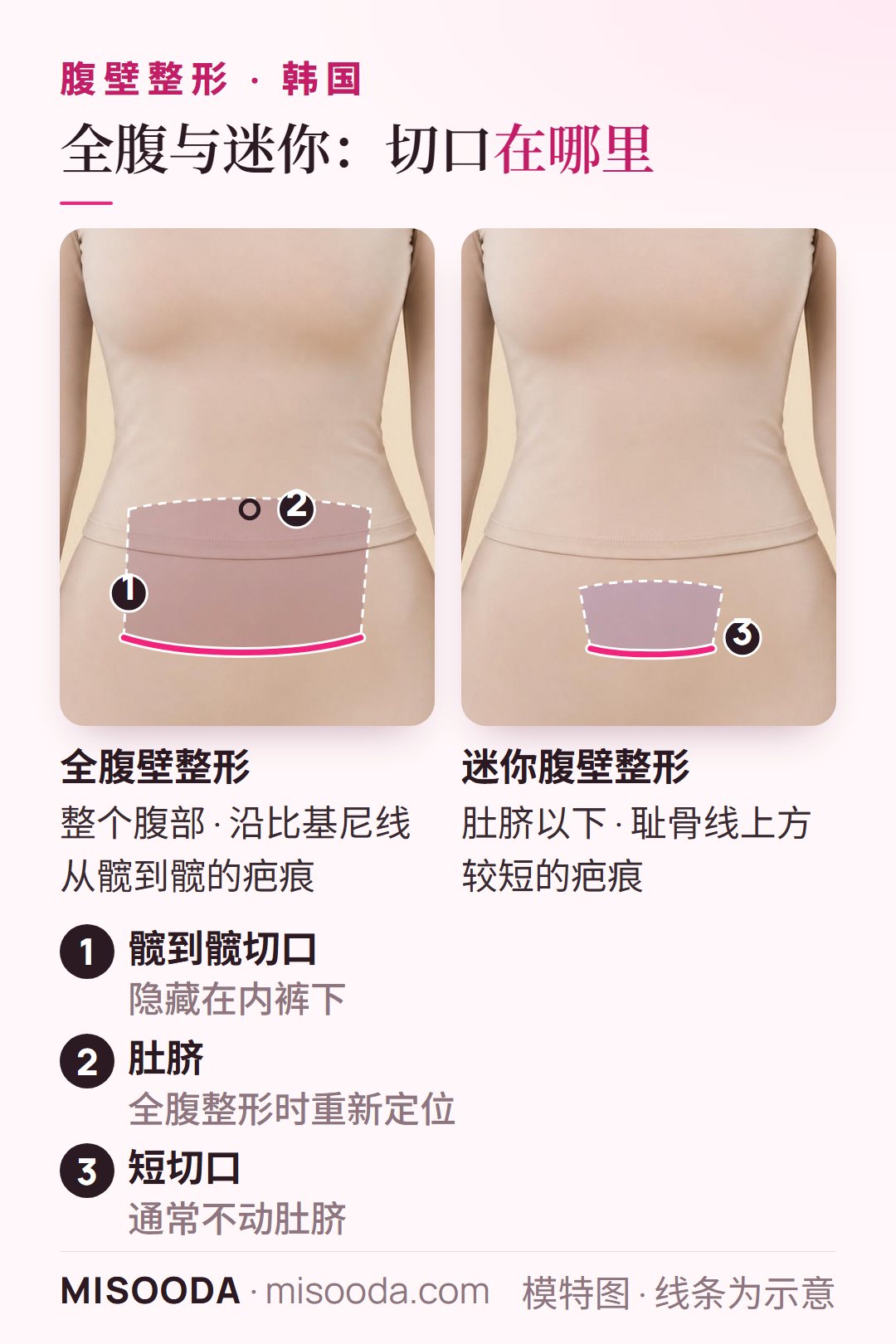韩国 全腹壁整形与迷你腹壁整形切口:沿比基尼线髋到髋的疤痕并重新定位肚脐,对比耻骨线上方较短的疤痕