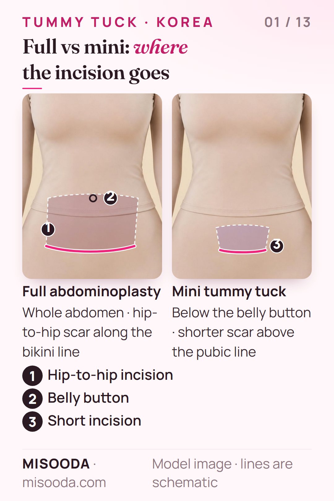 Full abdominoplasty vs mini tummy tuck incision: hip-to-hip bikini-line scar with belly button repositioned vs a shorter scar above the pubic line