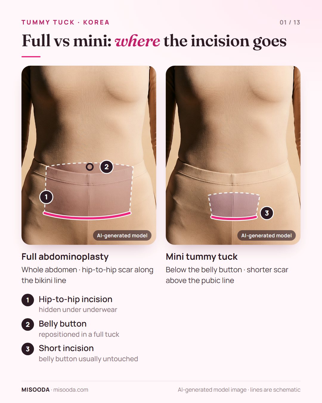 Full abdominoplasty vs mini tummy tuck incision: hip-to-hip bikini-line scar with belly button repositioned vs a shorter scar above the pubic line