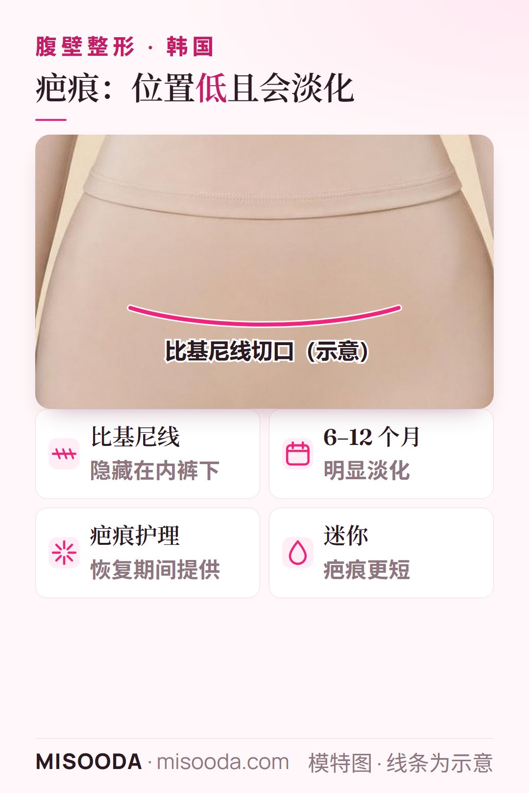 韩国 腹壁整形疤痕位于比基尼线,隐藏在内裤或泳衣下,配合疤痕护理在 6–12 个月内明显淡化
