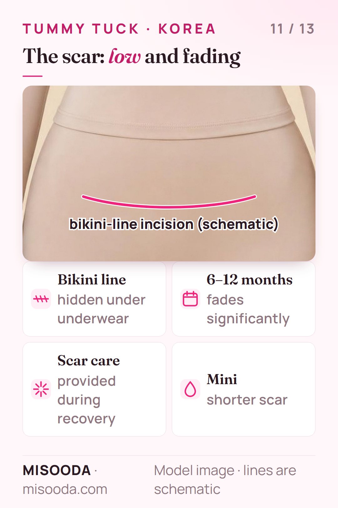 Tummy tuck scar along the bikini line, hidden under underwear or swimwear, fading significantly over 6–12 months with scar-care treatment