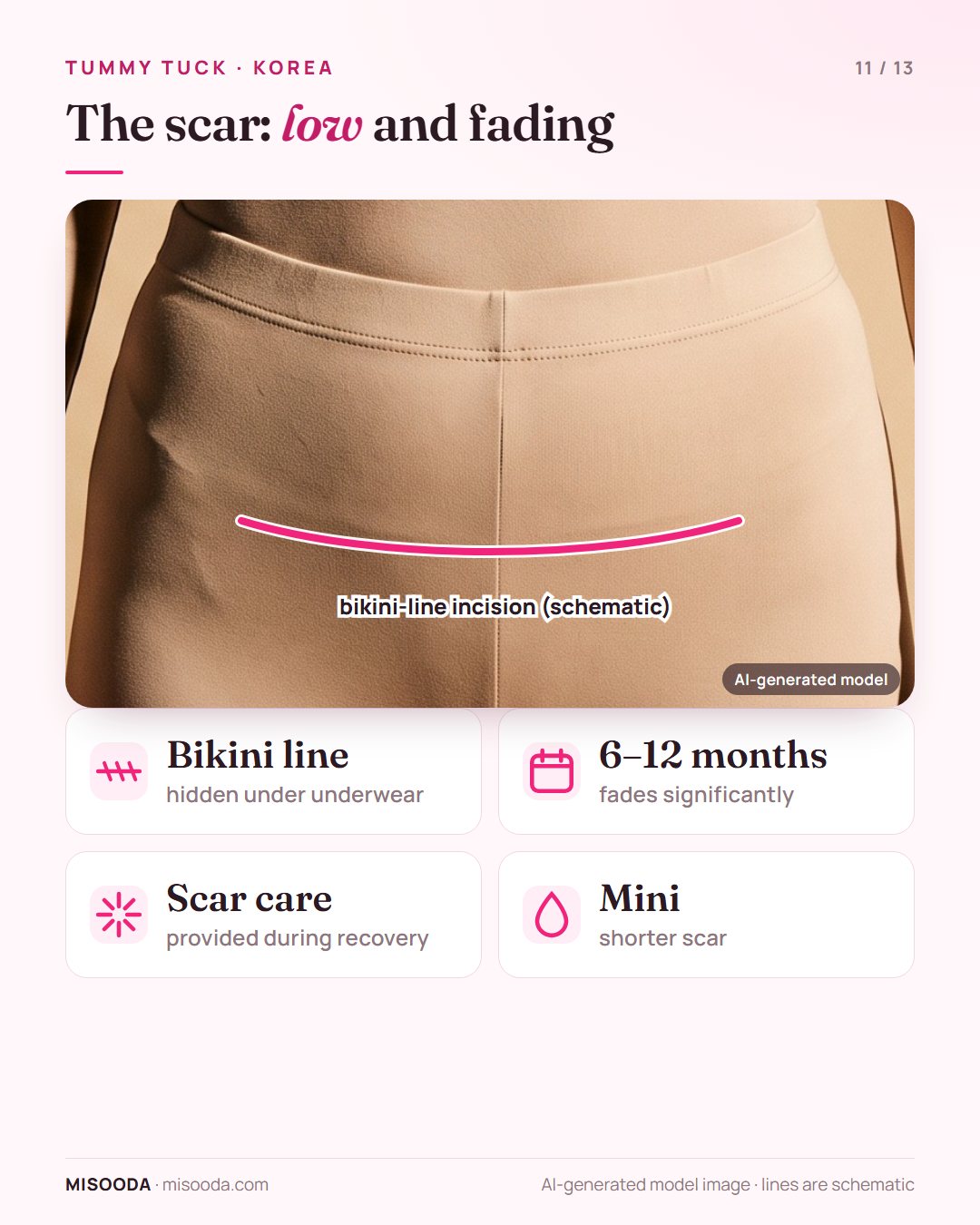 Tummy tuck scar along the bikini line, hidden under underwear or swimwear, fading significantly over 6–12 months with scar-care treatment