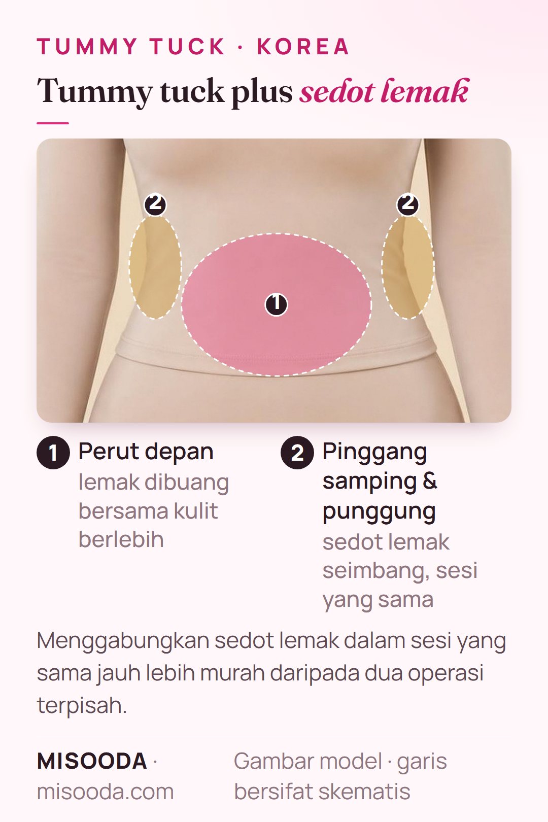 Tummy tuck dipadukan dengan sedot lemak di Korea: sedot lemak seimbang pada perut depan, pinggang samping dan punggung dalam sesi yang sama