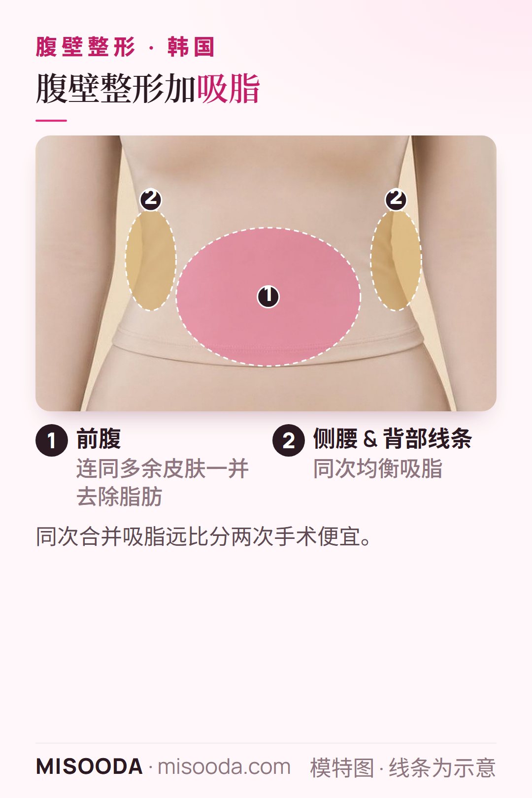 韩国 腹壁整形合并吸脂图解:在同一次手术中对前腹、侧腰与背部线条进行均衡吸脂,比分两次手术更省费用