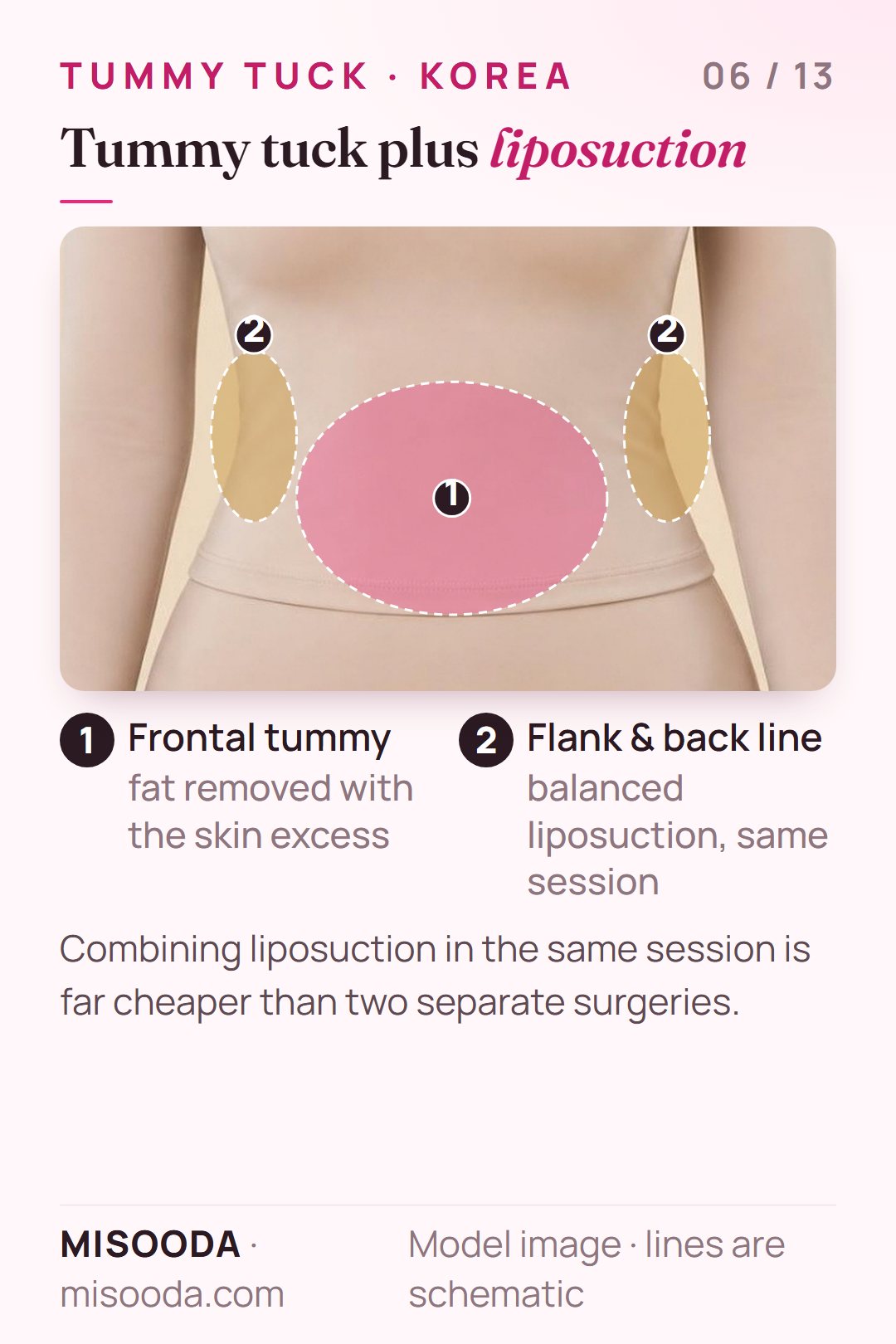Tummy tuck combined with liposuction in Korea: balanced liposuction of the frontal tummy, flank and back line in the same session