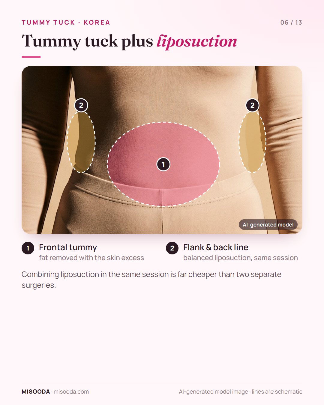Tummy tuck combined with liposuction in Korea: balanced liposuction of the frontal tummy, flank and back line in the same session