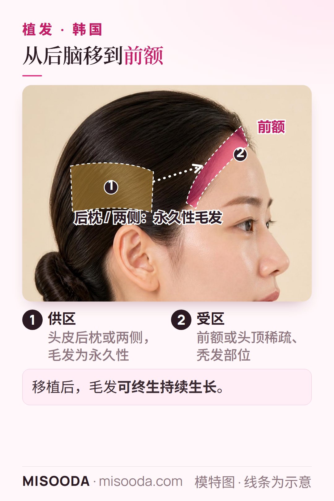 韩国 植发供区与受区示意图:从头皮后枕或两侧提取永久性毛发,移植到前额稀疏或秃发的部位,移植后毛发可持续生长