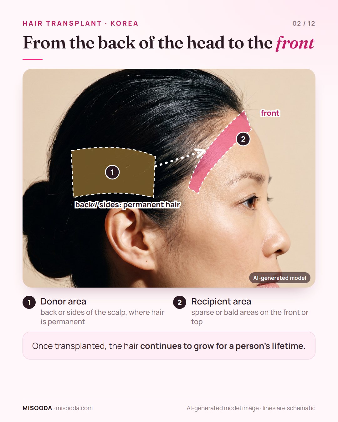 Hair transplant donor and recipient areas: permanent hair taken from the back or sides of the scalp and moved to sparse or bald areas at the front