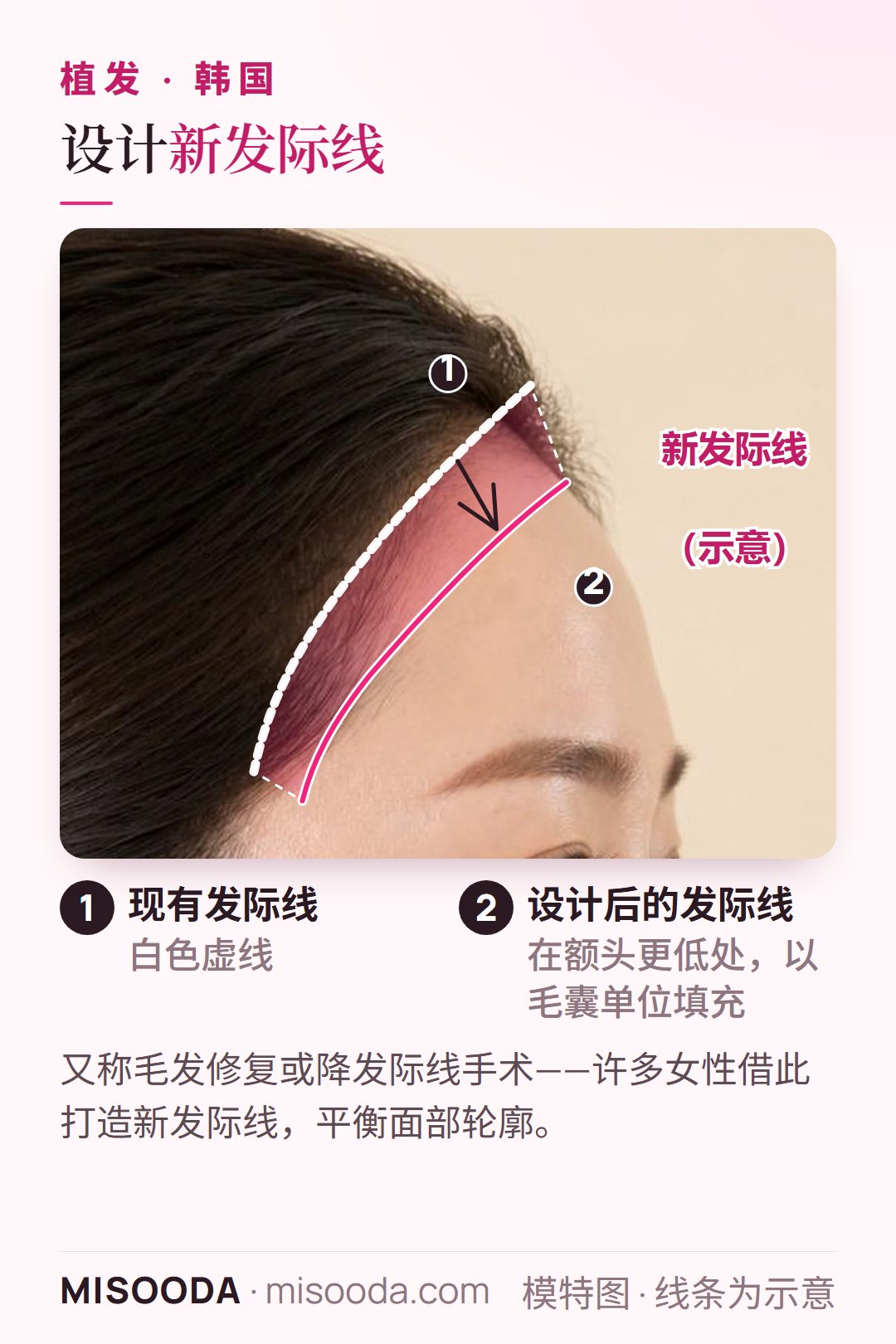 韩国 植发发际线设计侧面示意图:现有发际线,以及以毛囊移植单位填充、位置更低的新发际线,即降发际线手术的效果示意