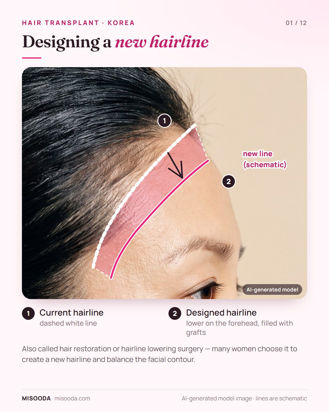 Hair transplant hairline design on a side profile: current hairline and a lower designed hairline filled with grafts, as in hairline lowering surgery