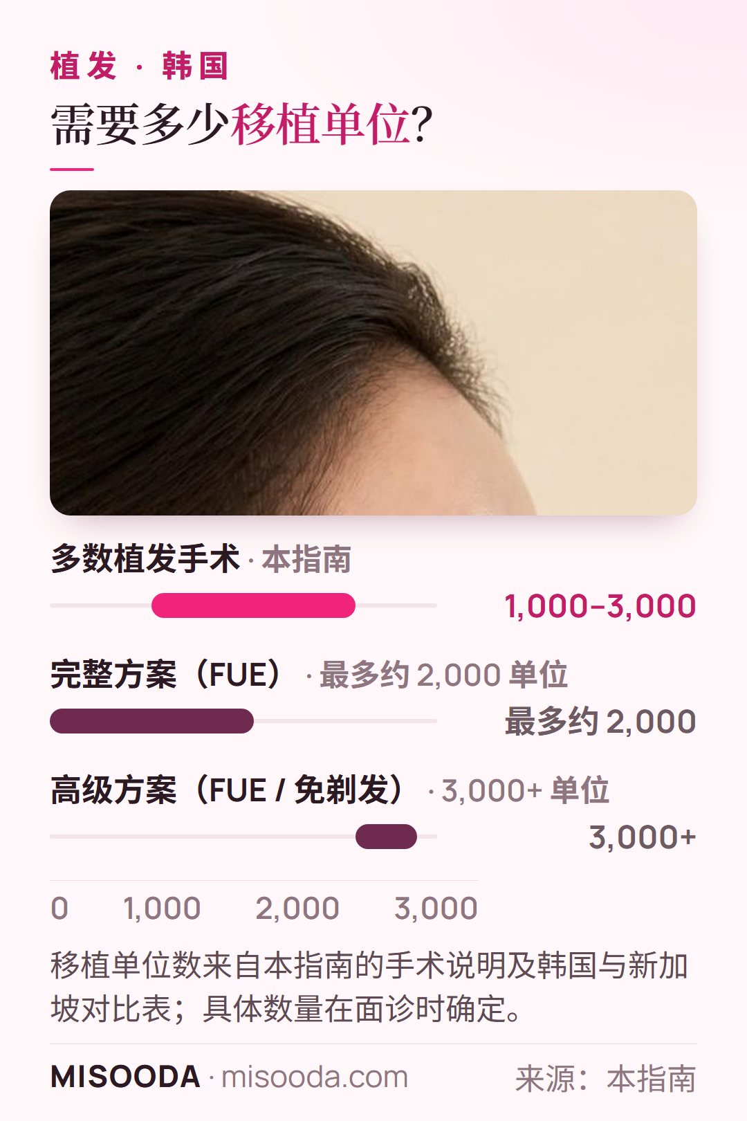 韩国 植发移植单位数:多数手术为 1,000–3,000 单位;完整 FUE 最多约 2,000 单位;高级免剃发 FUE 为 3,000+ 单位