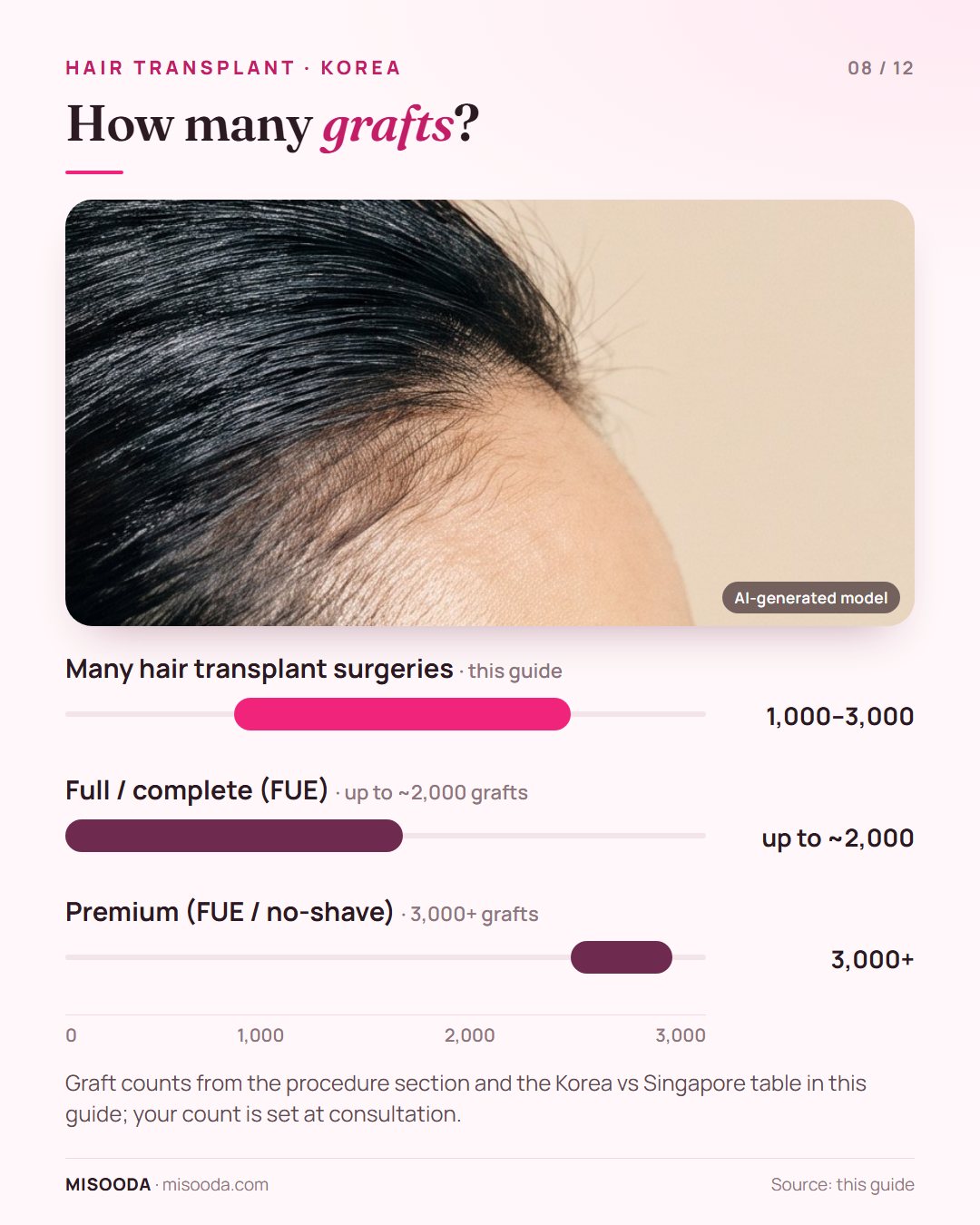 Hair transplant graft counts: many surgeries use 1,000–3,000 grafts; full FUE up to about 2,000 grafts; premium no-shave FUE 3,000+ grafts
