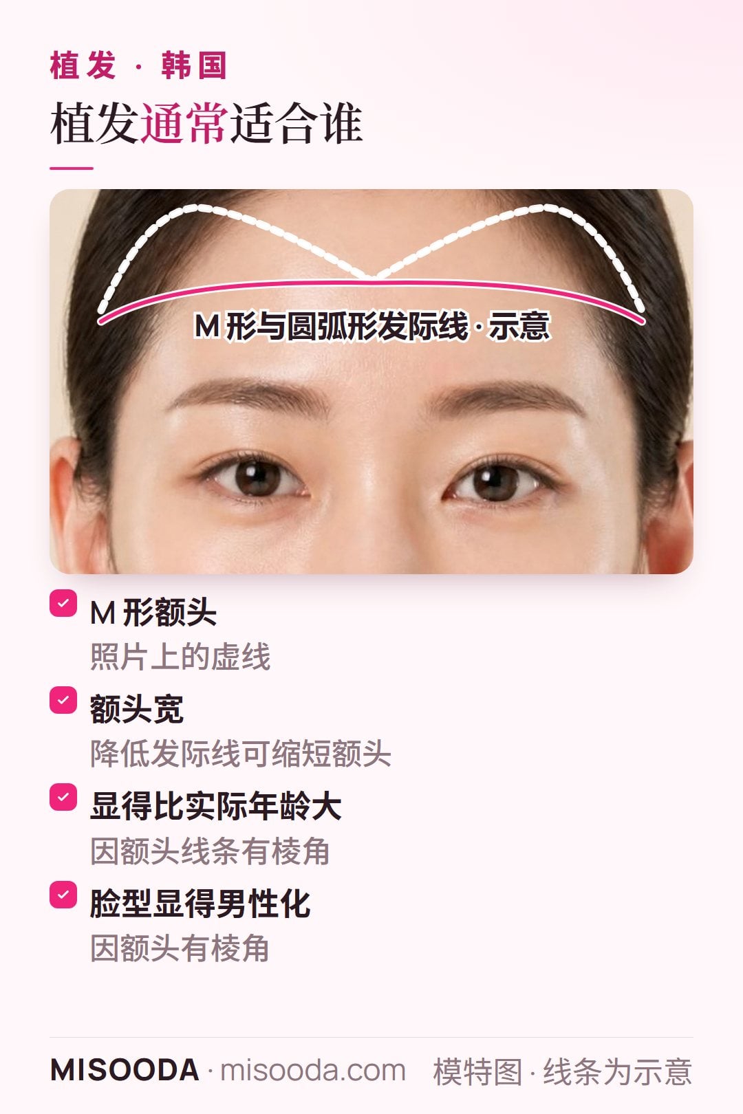 韩国 植发适合人群正面示意图:M 形额头、额头过宽,或因额头线条有棱角而显老、显得男性化的人
