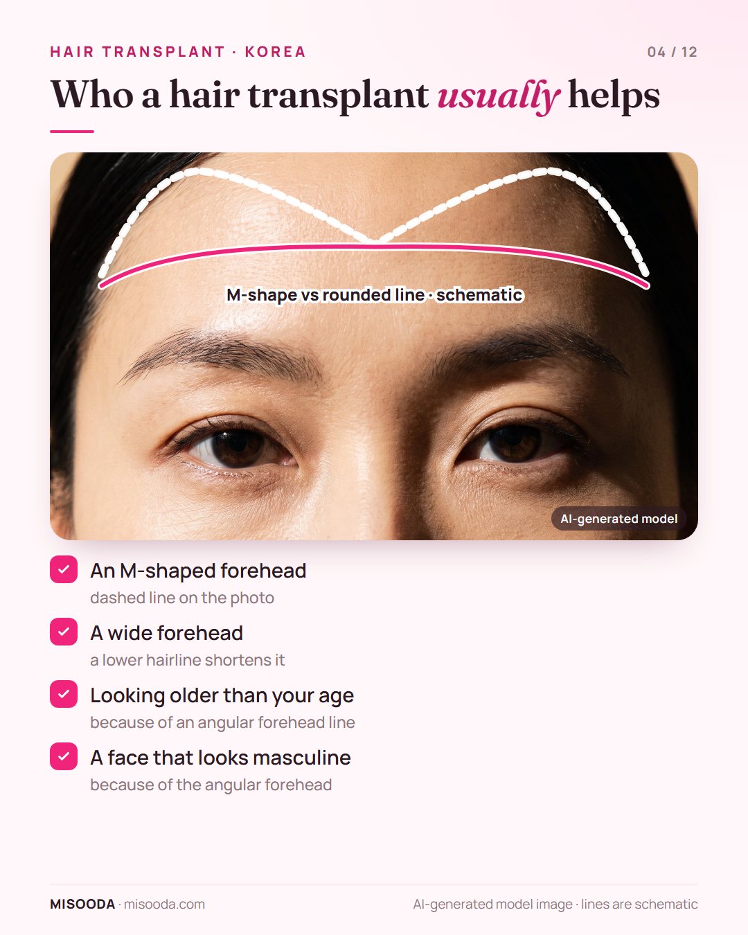 Hair transplant candidates: M-shaped forehead, wide forehead, looking older or masculine because of an angular forehead line, shown on a front view