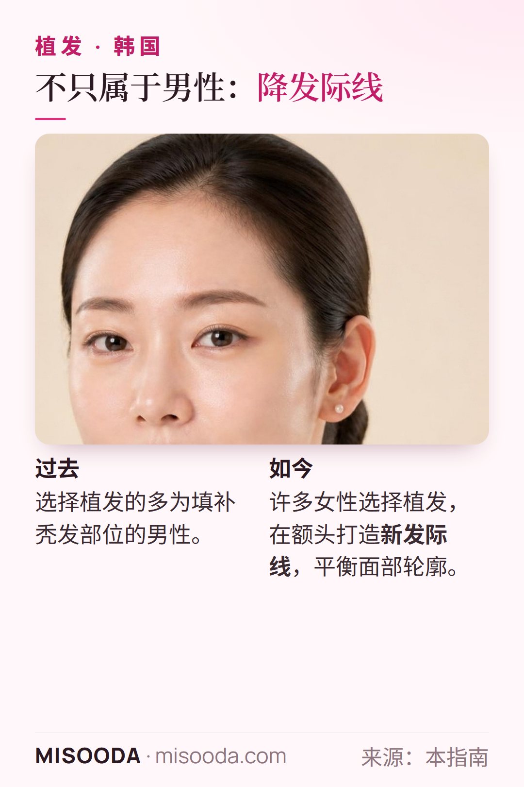 韩国 植发不再主要属于男性:许多女性选择降发际线手术,在额头打造新发际线,让面部轮廓更加协调