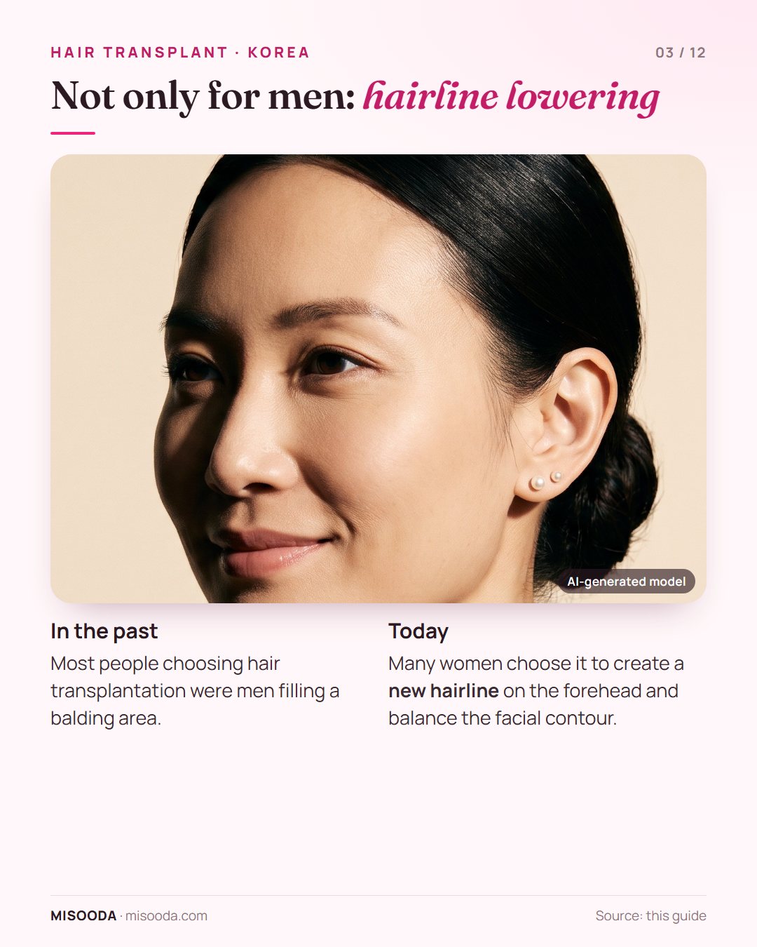 Hair transplant is no longer mainly for men: many women choose hairline lowering to create a new forehead hairline and balance their facial contour