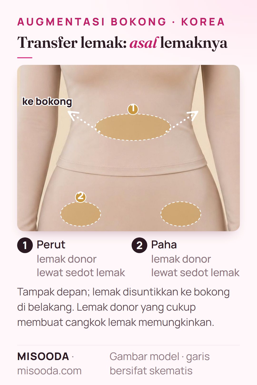 Augmentasi bokong transfer lemak (BBL): lemak donor diambil dari perut dan paha pada model berpakaian, lalu disuntikkan ke bokong