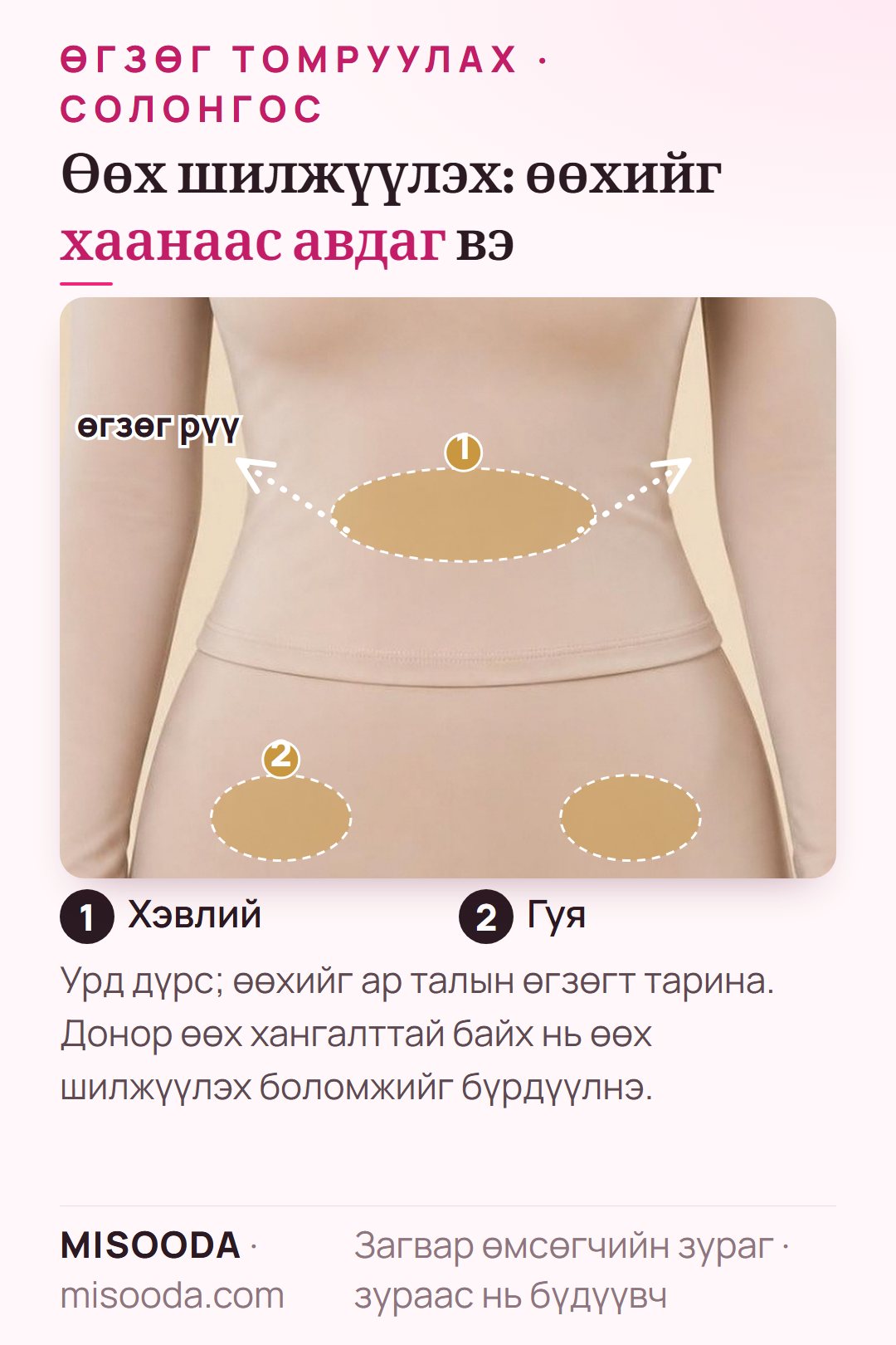 Өөх шилжүүлэх өгзөг томруулалт (BBL): хувцастай загвар дээр хэвлий, гуянаас донор өөх авч, өгзөгт тарих