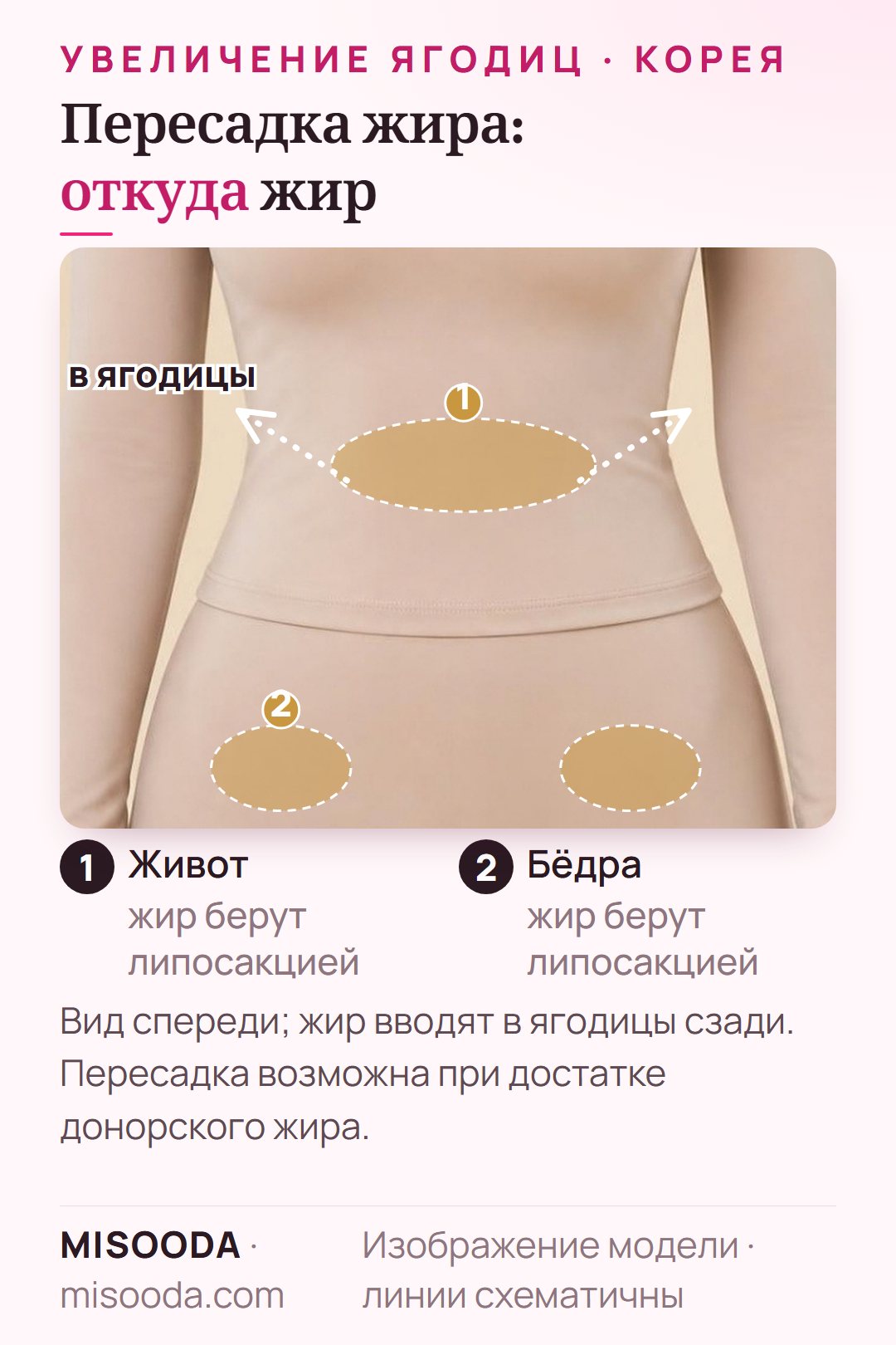 Увеличение ягодиц пересадкой жира (BBL): донорский жир берут с живота и бёдер, показано на модели в одежде, затем вводят в ягодицы