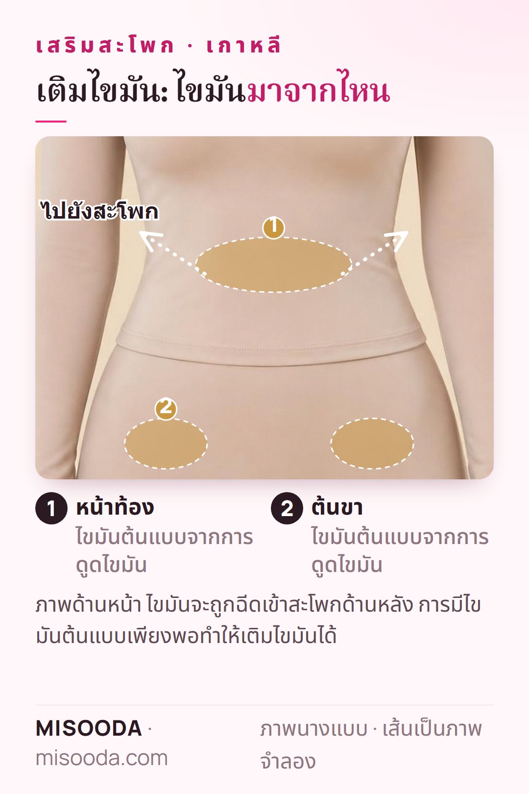 เสริมสะโพกด้วยไขมัน (BBL): นำไขมันต้นแบบจากหน้าท้องและต้นขา แสดงบนนางแบบที่สวมเสื้อผ้า แล้วฉีดเข้าสะโพก