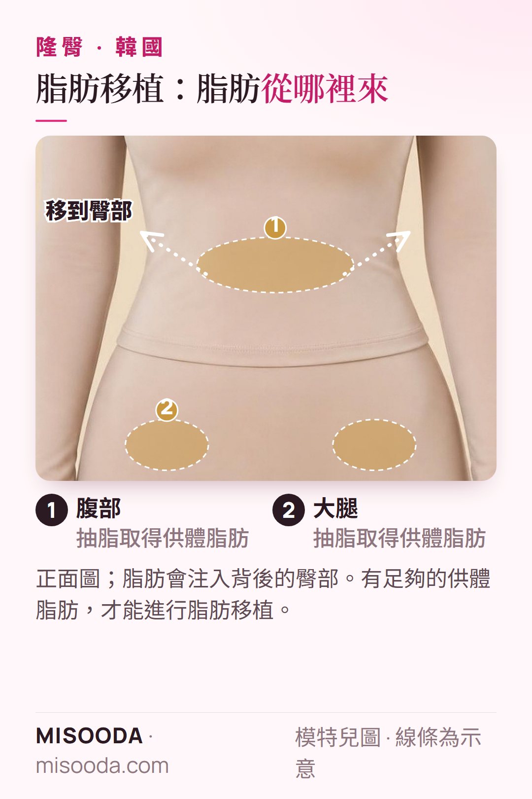 自體脂肪隆臀(BBL):從腹部與大腿取出供體脂肪,以著衣模特兒呈現,再注入臀部——韓國 隆臀