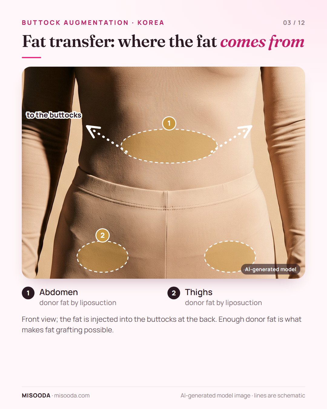 Fat transfer buttock augmentation (BBL): donor fat taken from the abdomen and thighs shown on a clothed model, then injected into the buttocks