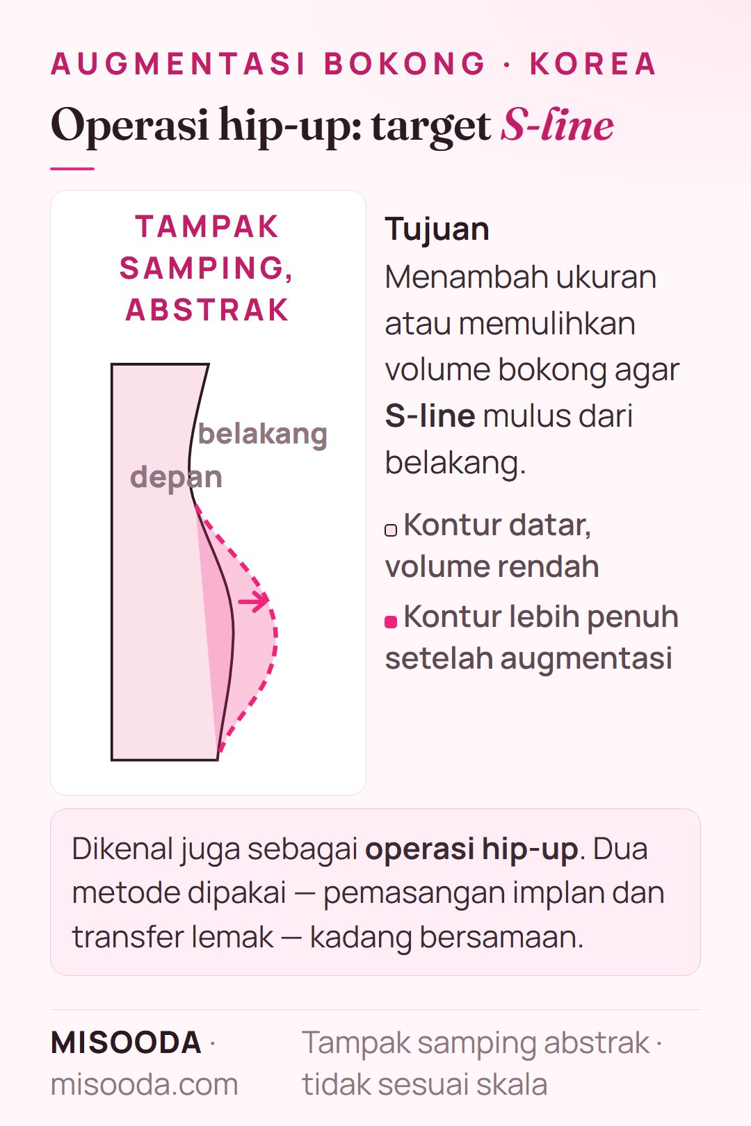 Tujuan augmentasi bokong (operasi hip-up) dalam tampak samping abstrak: kontur bokong datar dibuat lebih penuh untuk membentuk S-line dari belakang