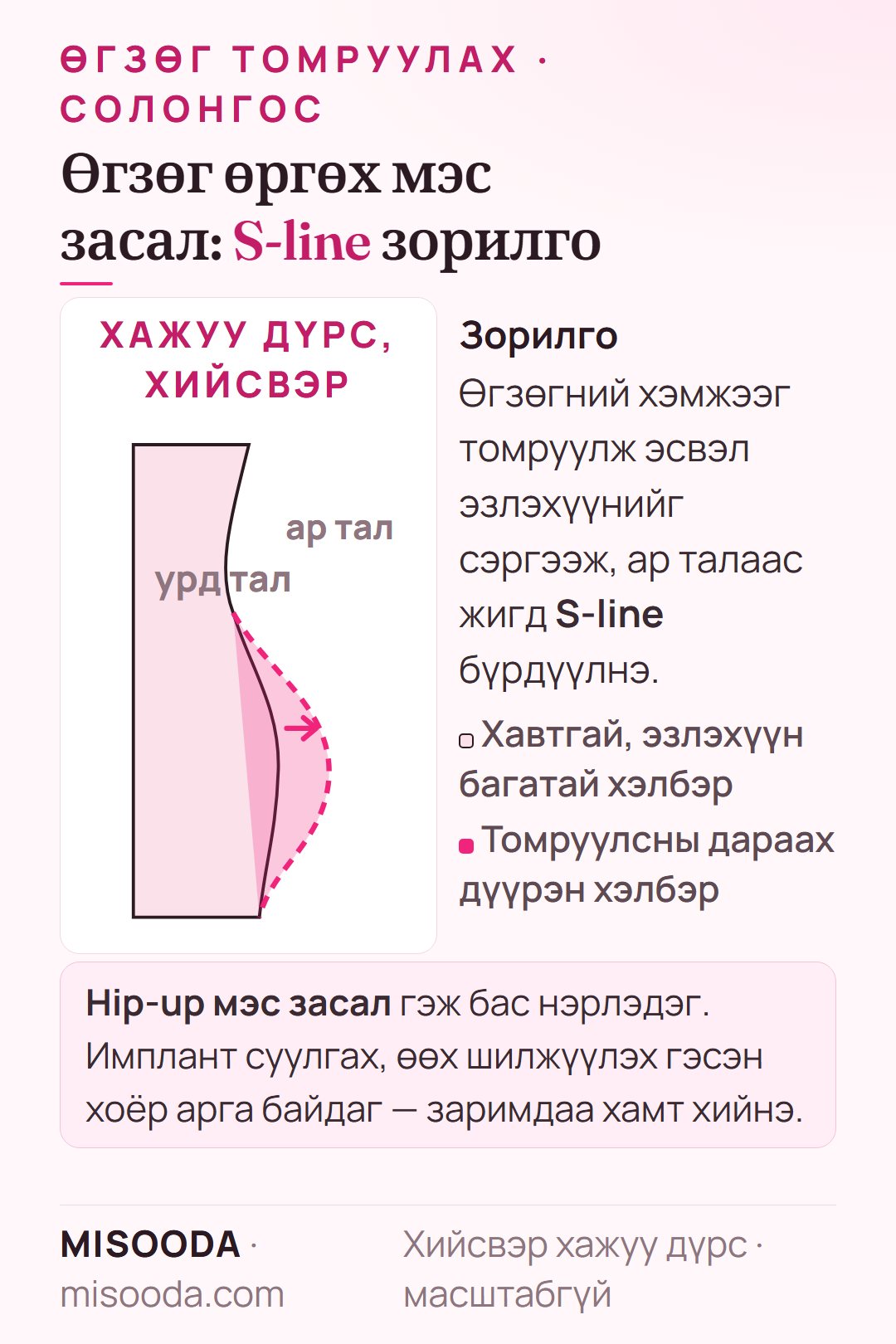 Өгзөг томруулах (hip-up) мэс заслын зорилго хийсвэр хажуу дүрсээр: хавтгай өгзгийг дүүргэж ар талаас S-line бүрдүүлэх