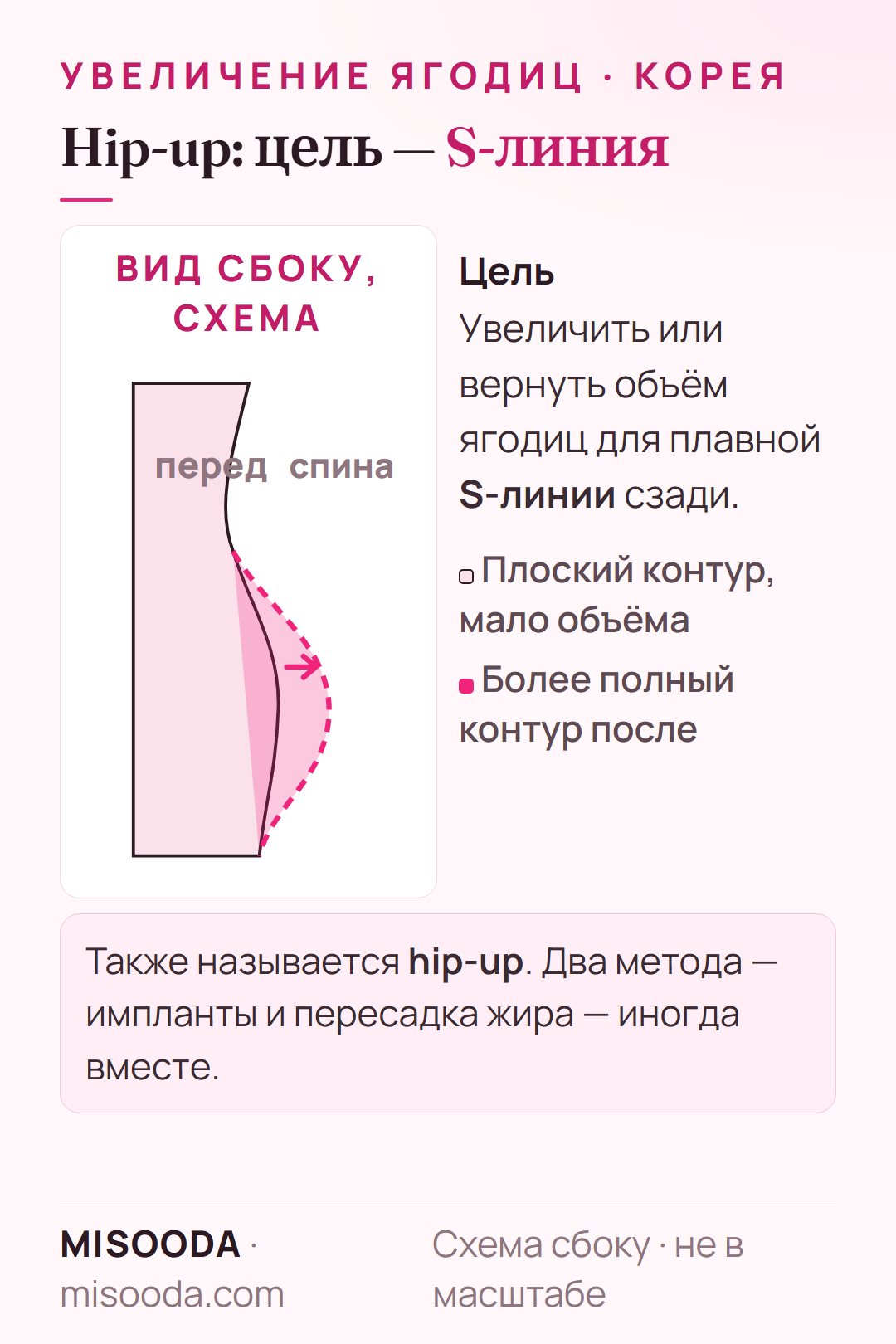 Цель увеличения ягодиц (hip-up) на схеме сбоку: плоский контур ягодиц становится более полным для S-линии сзади