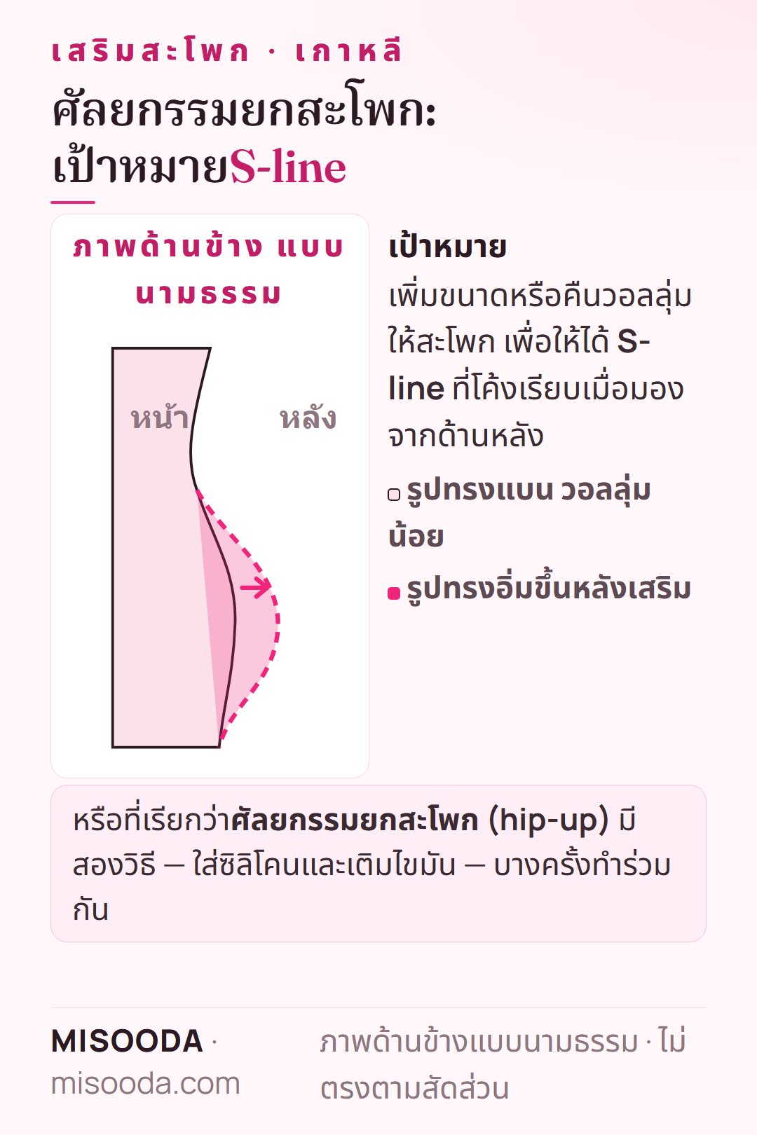 เป้าหมายการเสริมสะโพก (ยกสะโพก) เกาหลี แสดงเป็นภาพด้านข้างแบบนามธรรม: รูปทรงสะโพกแบนถูกเติมให้อิ่มขึ้นเพื่อให้ได้ S-line จากด้านหลัง